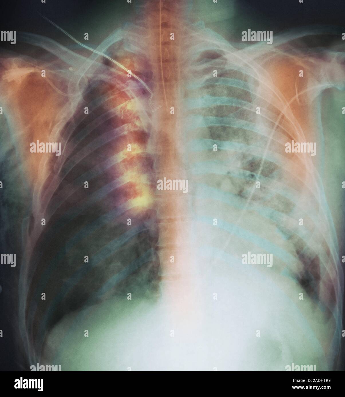 Gebrochene Rippen. Farbige Chest XRay zeigt mehrere gebrochene Rippen (orange), unten Mitte