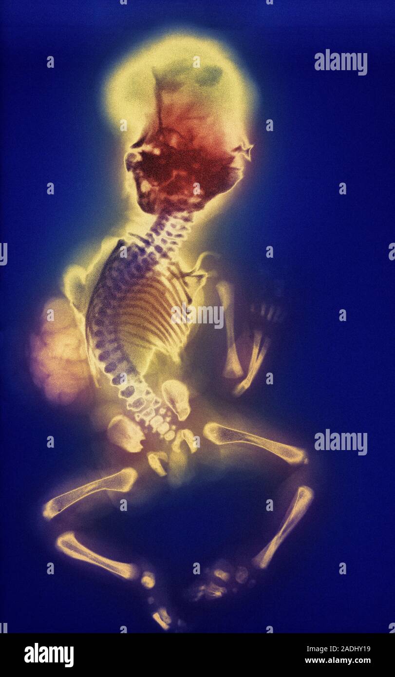 Verformte Fötus. Farbige Xray eines Fötus mit mehreren Deformitäten