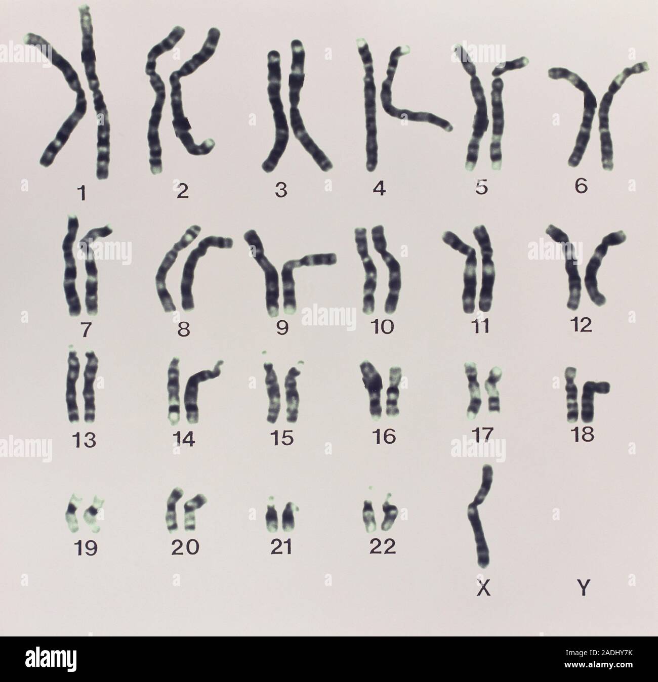 Turner syndrom Licht Schliffbild Der Chromosomen den Karyotyp Eines Turner syndrom Licht Schliffbild Der Chromosomen den Karyotyp Eines