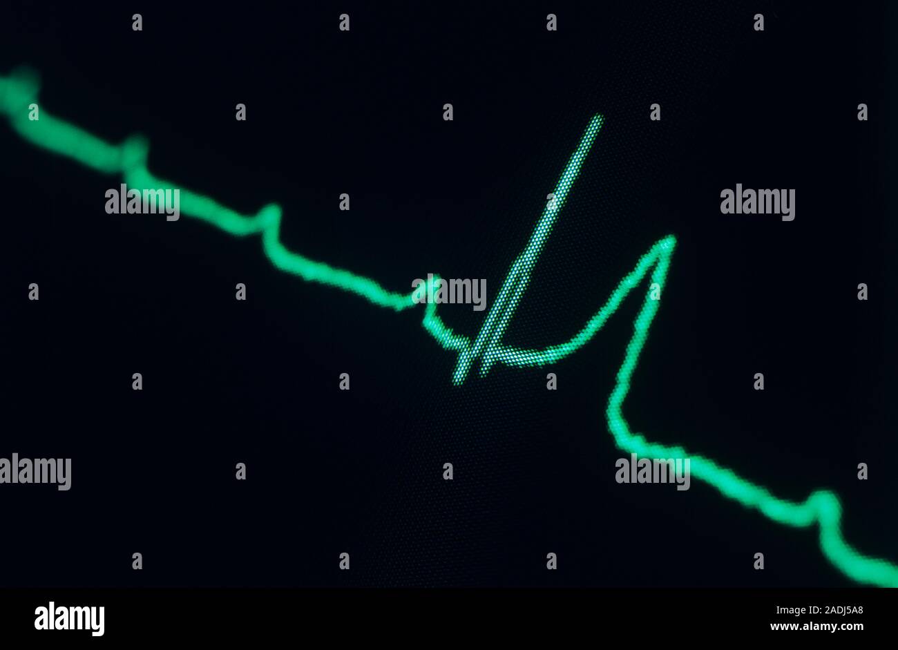 Elektrokardiogramm (EKG), dritten Grades (auch als komplette) Herz