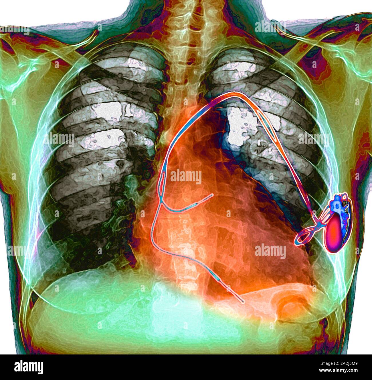 Herzschrittmacher. Farbige Chest XRay ein chirurgisch implantierte