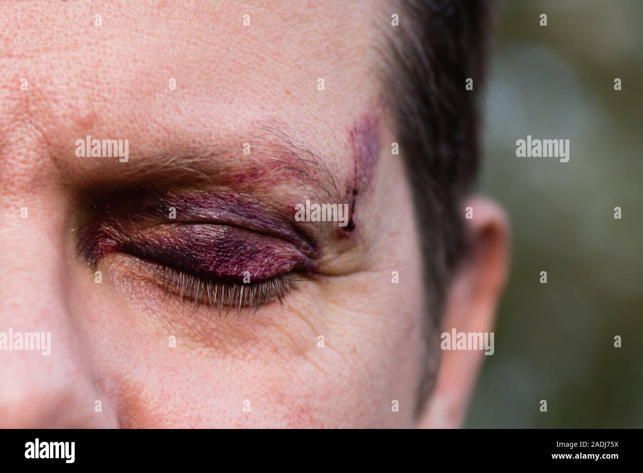 Nahaufnahme von einem weißen Mann mit einem Lila schwarz Auge und Kopf Verletzung - Auge geschlossen Stockfoto