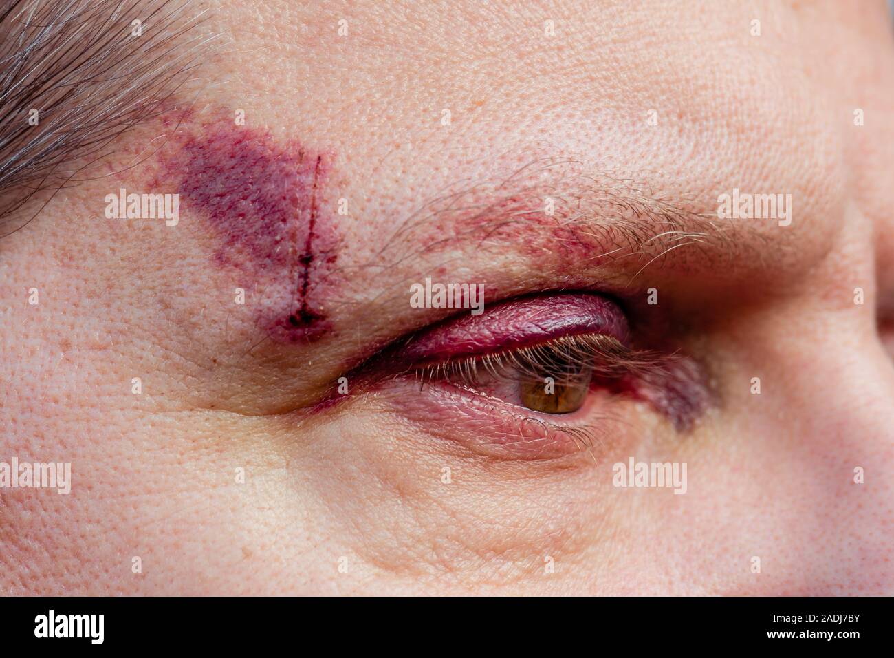 Ein weißer Mann mit einem Lila schwarz Auge und Kopf Verletzung - Auge öffnen, Seitenansicht Stockfoto
