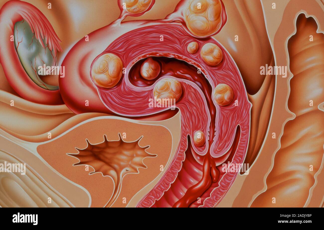 Was Ist Ein Myom In Der Gebärmutter www.alamy.de