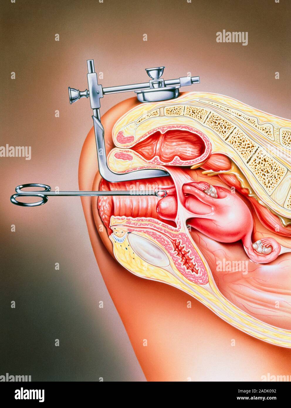 Abbildung: Weibliche Sterilisation. Dies ist in der Regel eine dauerhafte  Methode der contracep- tion, in der die Eileiter verschlossen sind oder t  Stockfotografie - Alamy