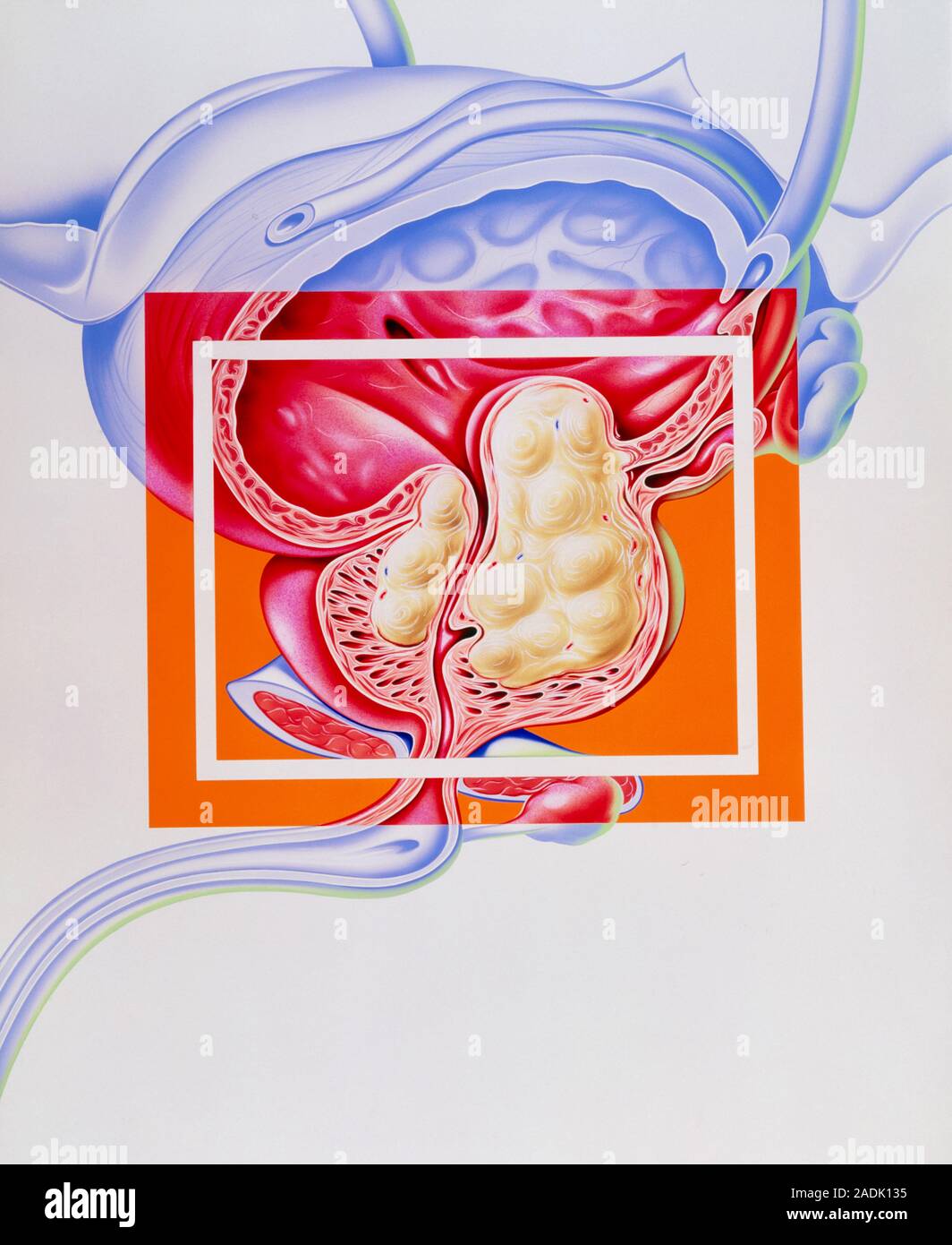 Benigne Prostatahyperplasie. Abbildung einer Prostata ausstellenden noduläre Hyperplasie, oder die Zellproliferation. Die knötchen (Creme wirbelt, bei CE Stockfoto