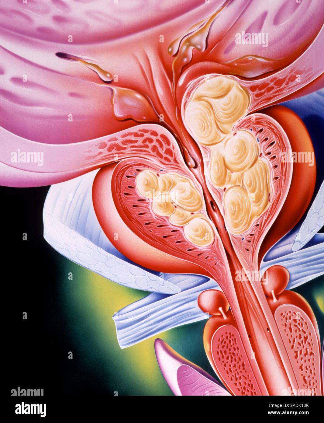 Benigne Prostatahyperplasie. Kunstwerk eines Prostata (Rot, Mitte rechts) mit noduläre Hyperplasie, oder die Zellproliferation. Die knötchen (Creme swir Stockfoto