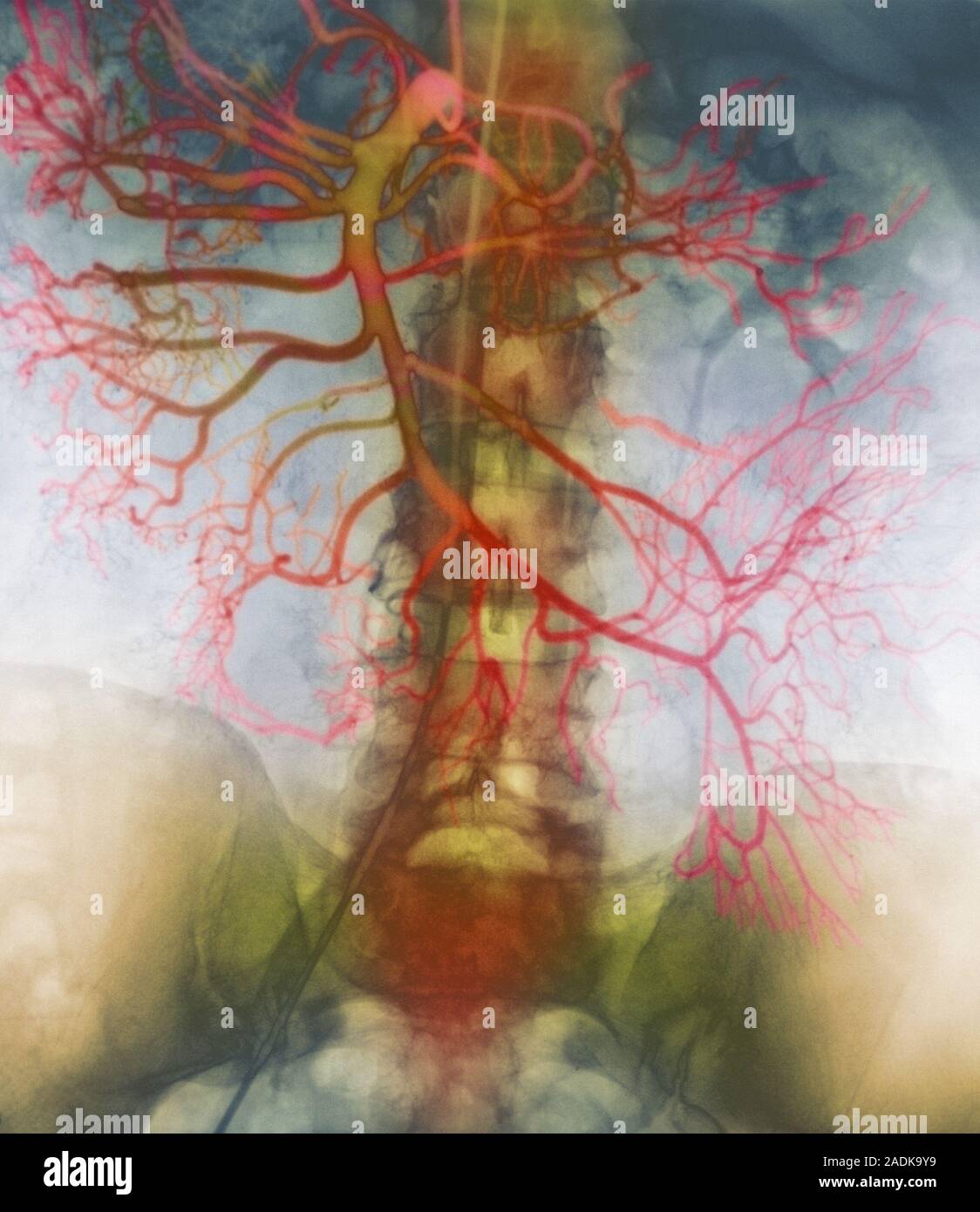 Mesenterialen Arterien. Farbige Angiogramm (X-ray) der Verzweigung A ...