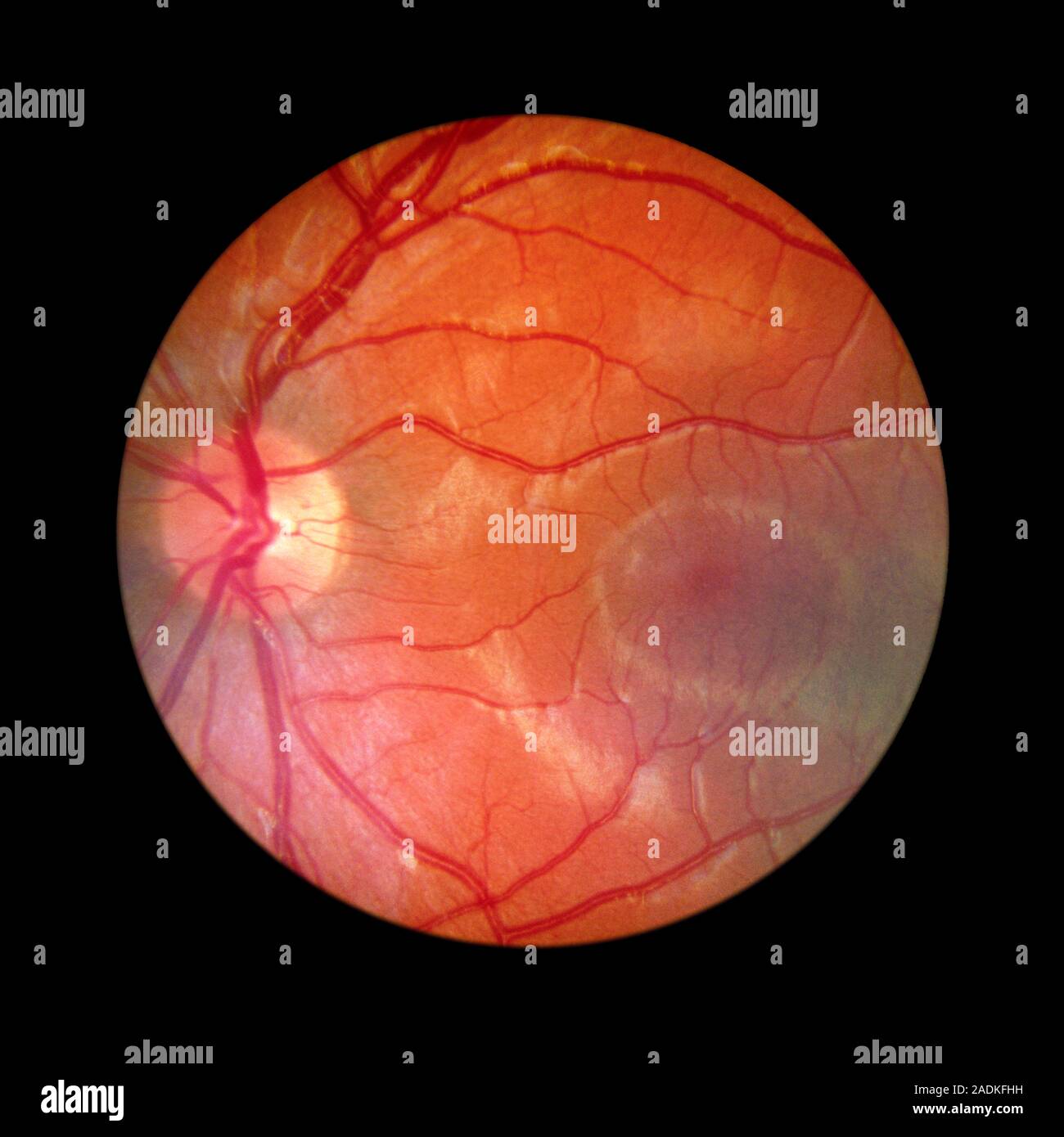 Funduskamera Bild der Netzhaut eines normalen Auge, die Verteilung der retinalen Venen und Arterien: Die zentrale retinalen Arterien (ein Zweig der t Stockfoto