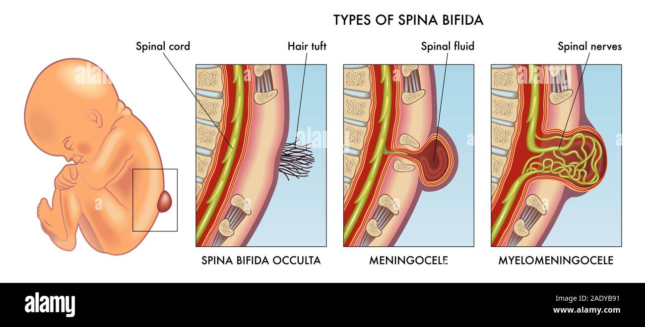 Medizinischen Abbildung des Säuglings Spina bifida mit Beschriftung. Stockfoto