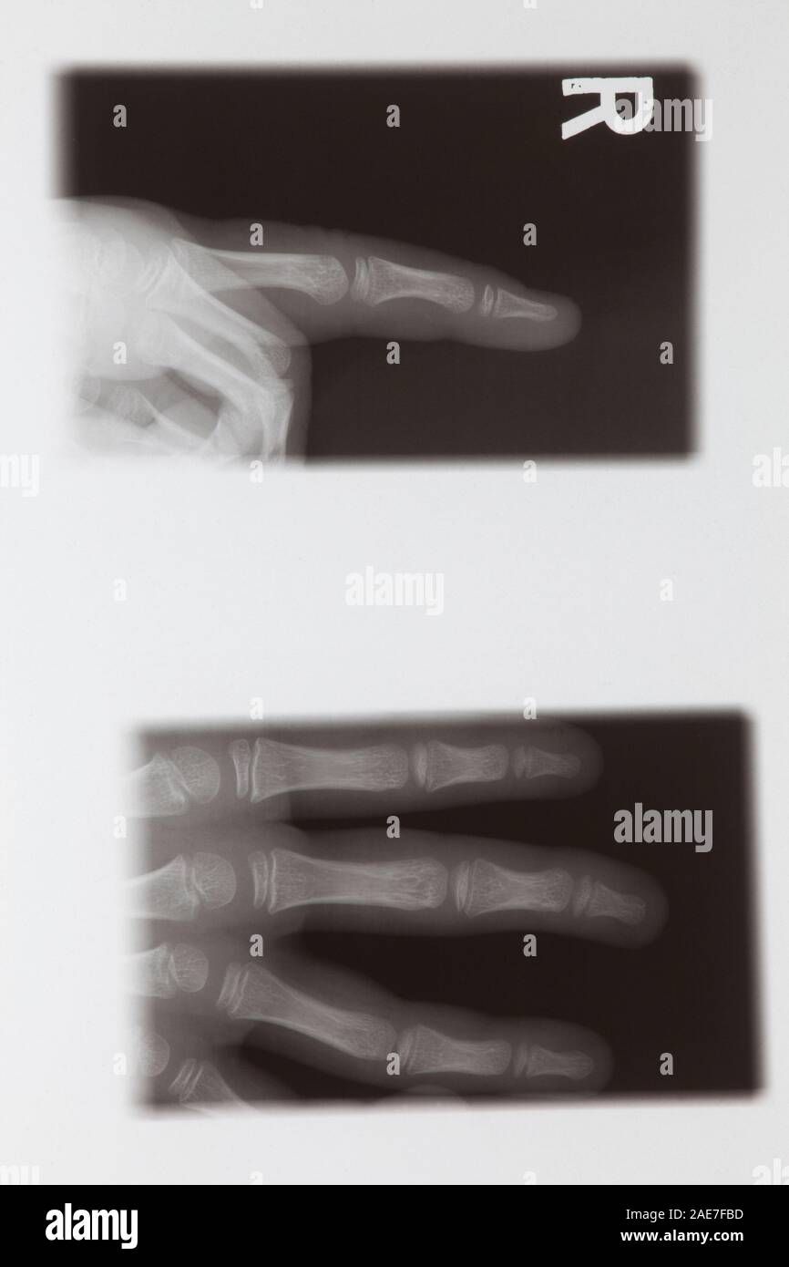 Weibliche hand X-ray Stockfoto