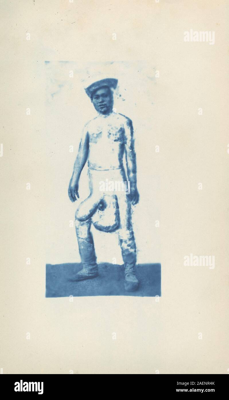 Um 1870er Jahre medizinische Illustration, die einen Patienten mit Elephantiasis zeigt und geschwollene Gliedmaßen und Hautveränderungen hervorhebt, die typisch für die Krankheit sind, verwendet für wissenschaftliche Studien. Stockfoto