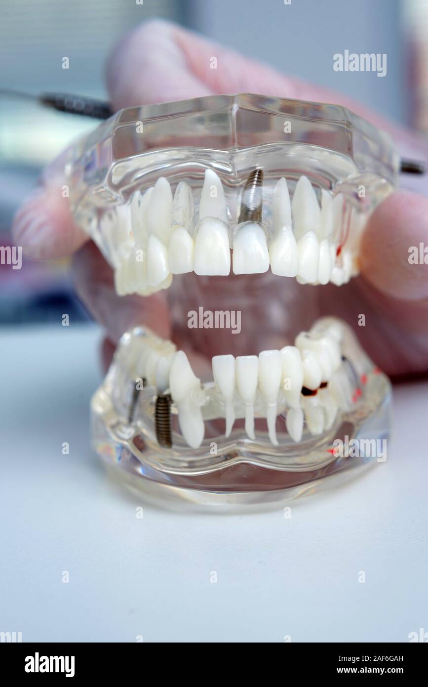 Kieferorthopäden hält ein Modell der Zähne mit Implantaten Stockfoto