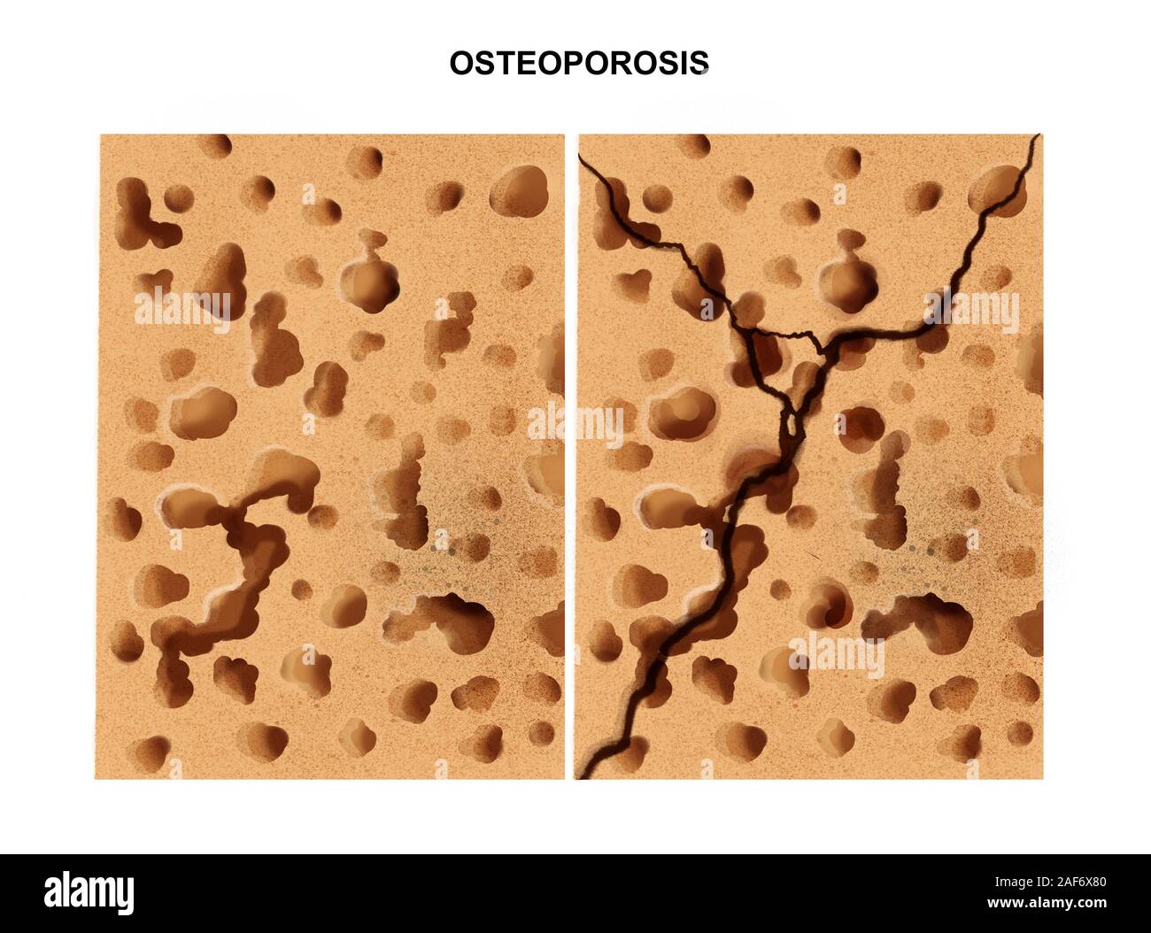 Abbildung: der Prozess der Osteoporose Stockfoto