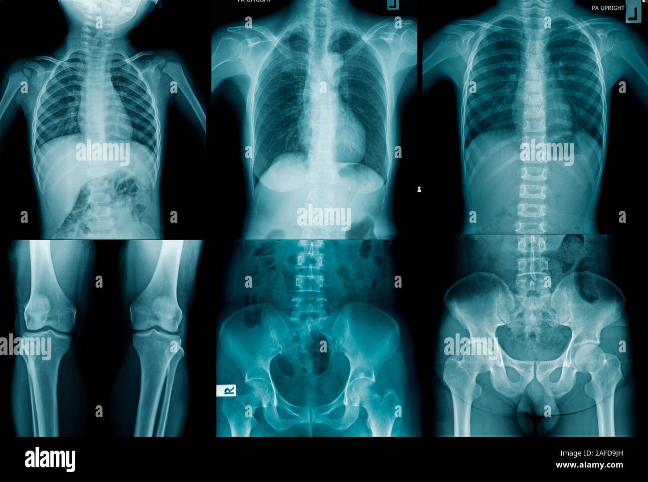 Sammlung menschlichen x-ray Bild in blauen Ton Stockfoto