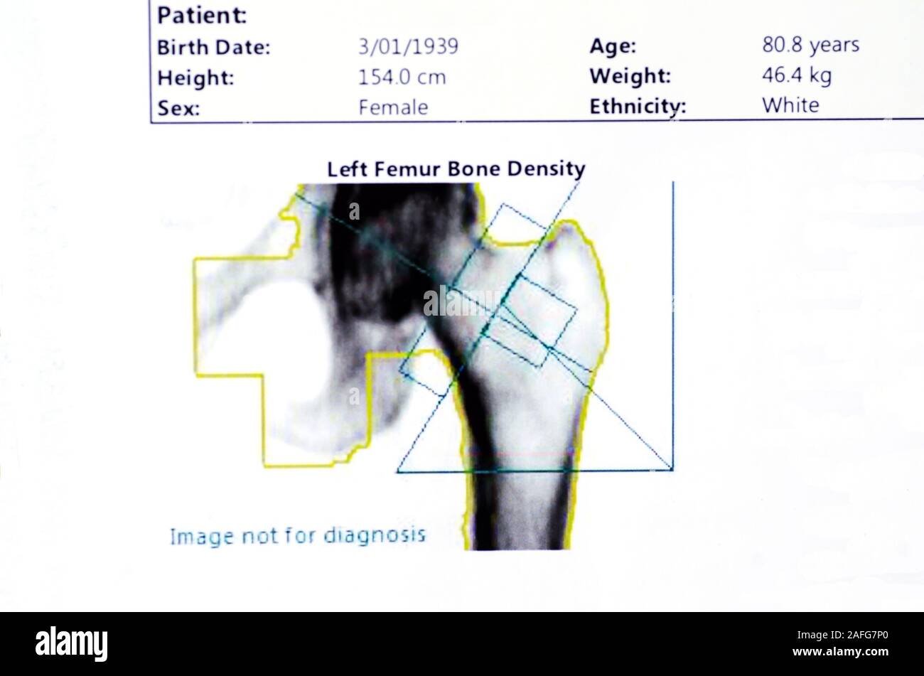 Knochendichtescan des linken Oberschenkels eines weiblichen Patienten im Alter von 80 Jahren. Stockfoto