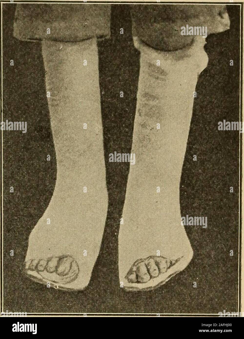 . Postoperative Behandlung; der Inbegriff der Geschäftsleitung der postoperativen Versorgung und Behandlung von chirurgischen Fällen, die von Prominenten Amerikanischen und Europäischen Chirurgen praktiziert. r Die Konsolidierung in der neuen Position. Bei thistime fast keine Anzeichen von Operation bleibt, außer, vielleicht, leichte Verfärbung der Haut. Der Fuß ist wieder gehalten soweit aspossible in der unterkorrektur Posi-tion und ein anderes Pflaster Pflaster angewendet wird, in der Regel so weit wie nur die Knie. Dies bleibt für vier Wochen oder länger, wenn es ist immer noch ungebrochen. Der Patient verwendet den Fuß ständig, und ist in der richtigen m gebohrt Stockfoto