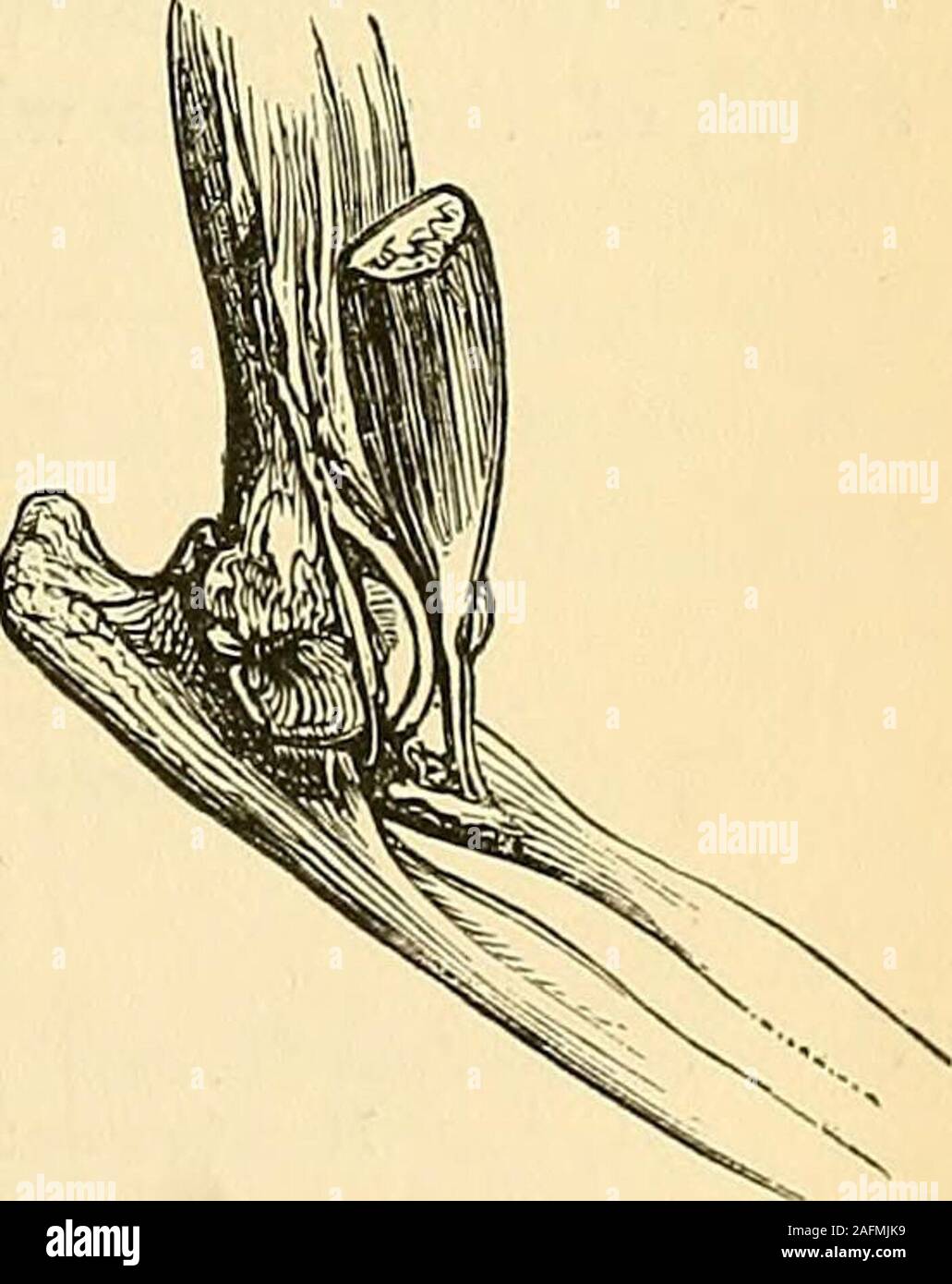 . Die Grundsätze und die Praxis der Chirurgie. Ards, andforwards. Die beiden seitlichen Luxationen sind in der Regel unvollständig. Versetzungen von Radius und ULNA Rückwärts. verursachten innersten Fällen durch einen Sturz auf die Hand, aber gelegentlich durch einen Schlag auf: Diehintere des Arms, oder durch eine Torsion des Winkelstücks. In dieser Verschiebung der Unterarm ist in der Regel Fls - 132 - leicht auf den Arm gebeugt, und Pronated. Der Radius zu spüren ist seine articu- lation verlassen zu haben, und die Olecranon Projekte posterior. Manchmal am unteren Ende des Humerus Kannmit vor fühlte. Sehr oft ist es für einen Bruch der unteren Ende der Hu verwechselt Stockfoto