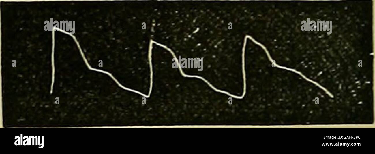 . Erkrankungen des Herzens und der thorakalen Aorta. Druck 3 oz. 276.-Aneurysma der linken A. axillaris (rechts radial). Rechts radial tracingfor denselben Patienten. Der Puls ist intermittierend, aber alle werden die Kurven wellmarked.. Abb. 277.- (Links radial). Druck ^^oz. Abb. 278.- (radial). Presstireloz. Feigen. 277 und 278.-Aneurysma der Linken Subclavia.-^ J. M., eingestellt. 50, Newcastle Krankenstation 5. September 1878 zugelassen sind; alle Wellen in der linken Tracing werden ausgelöscht. Betroffen sind, seine Kurven Quoad in einer hke Grad. (Siehe Abbn. 279 und 280.) Wenn die aneurismal Sac beinhaltet die Innominate, Subcl Gummilagers Stockfoto