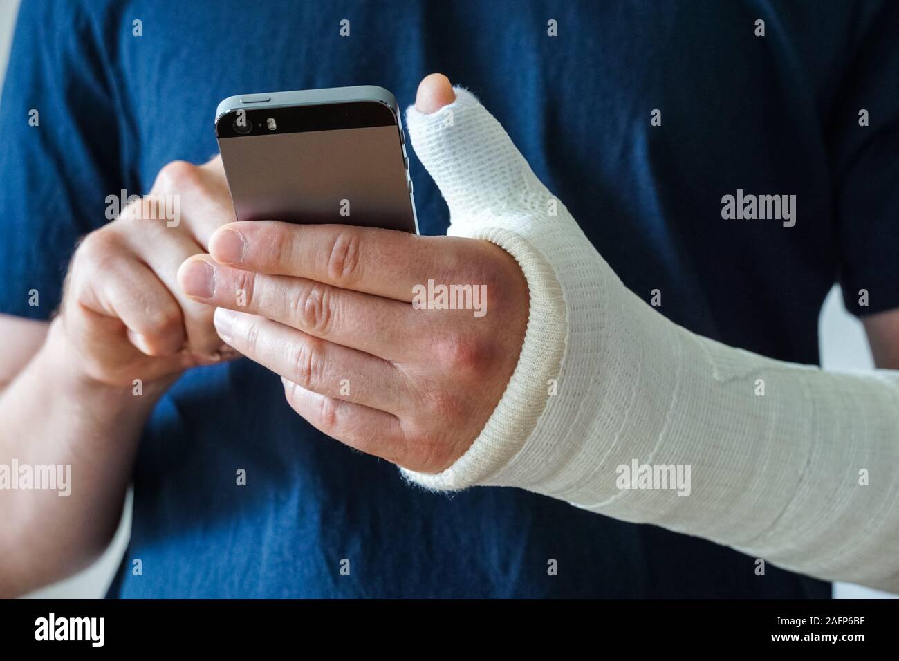 Mann mit Gips auf gebrochene Hand gegossen, gebrochenen Daumen, gebrochenes Handgelenk mittels Smartphone Stockfoto