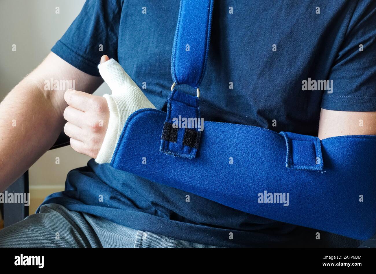 Mann mit Gips auf gebrochenen Daumen gegossen, gebrochenes Handgelenk, gebrochene Hand am Arm Schlinge Stockfoto