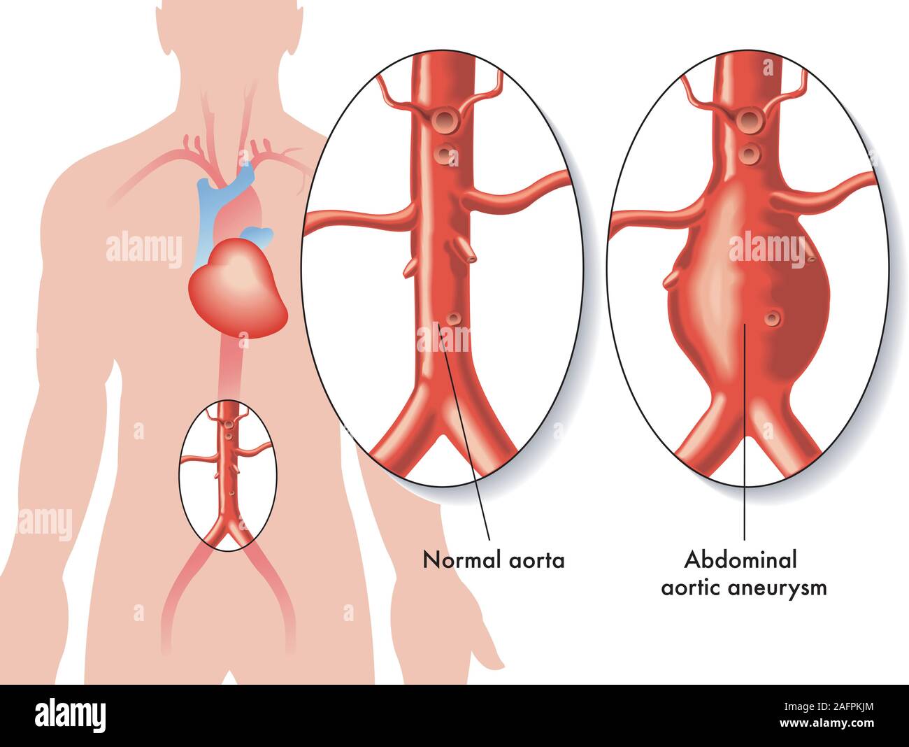 Medizinische Illustration der Auswirkungen von abdominalen Aortenaneurysmen. Stock Vektor