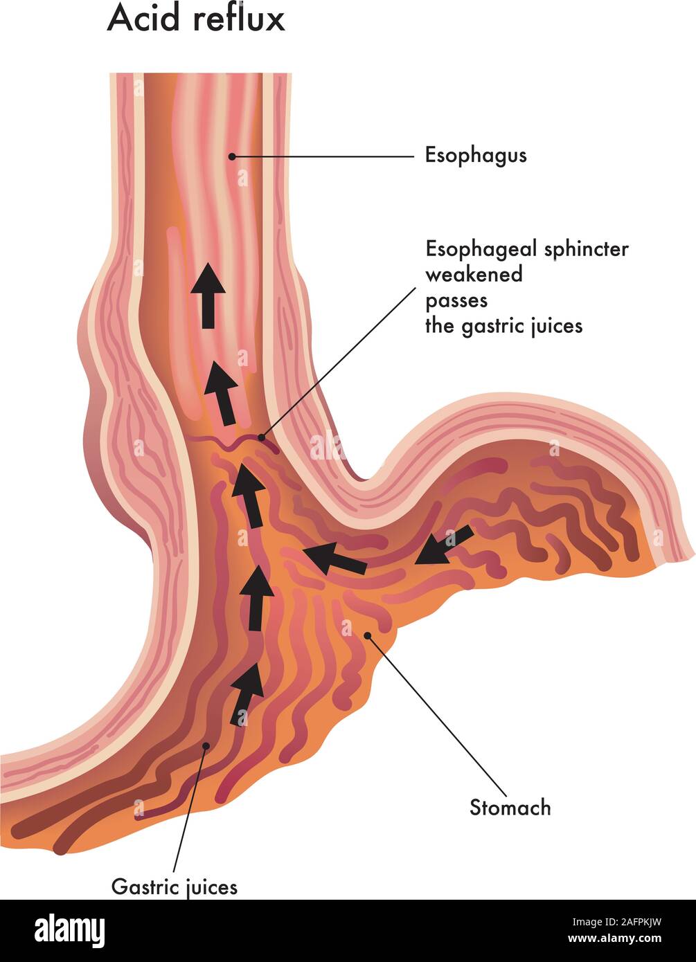 Medizinische Illustration der Auswirkungen des sauren Rückfluß. Stock Vektor