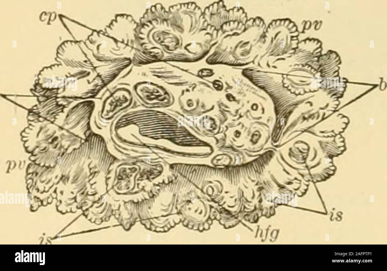 . Klinische gyncology, medizinische und chirurgische. Krebsartigen Entartung zu unterziehen ist bekannt, aber so pauschal eine Aussage wie die von Wells, dass sie bösartige areall, natürlich Basierend auf der klinischen anstatt auf anatomicalobservations. Die cancerous ändern kann zu kleinen Portionen der Zyste, erkennbar nur auf sorgfältige mikroskopische Untersuchung beschränkt sein oder Es mayinvolve das gesamte Wachstum und durch Metastasen in distantorgans begleitet werden. Die Frage der Bildung von Metastasen in Verbindung mit einfachen nicht-malig - Nant papillomatous Zysten interessant ist au, und ist von großer importancesurgically. Durch Stockfoto