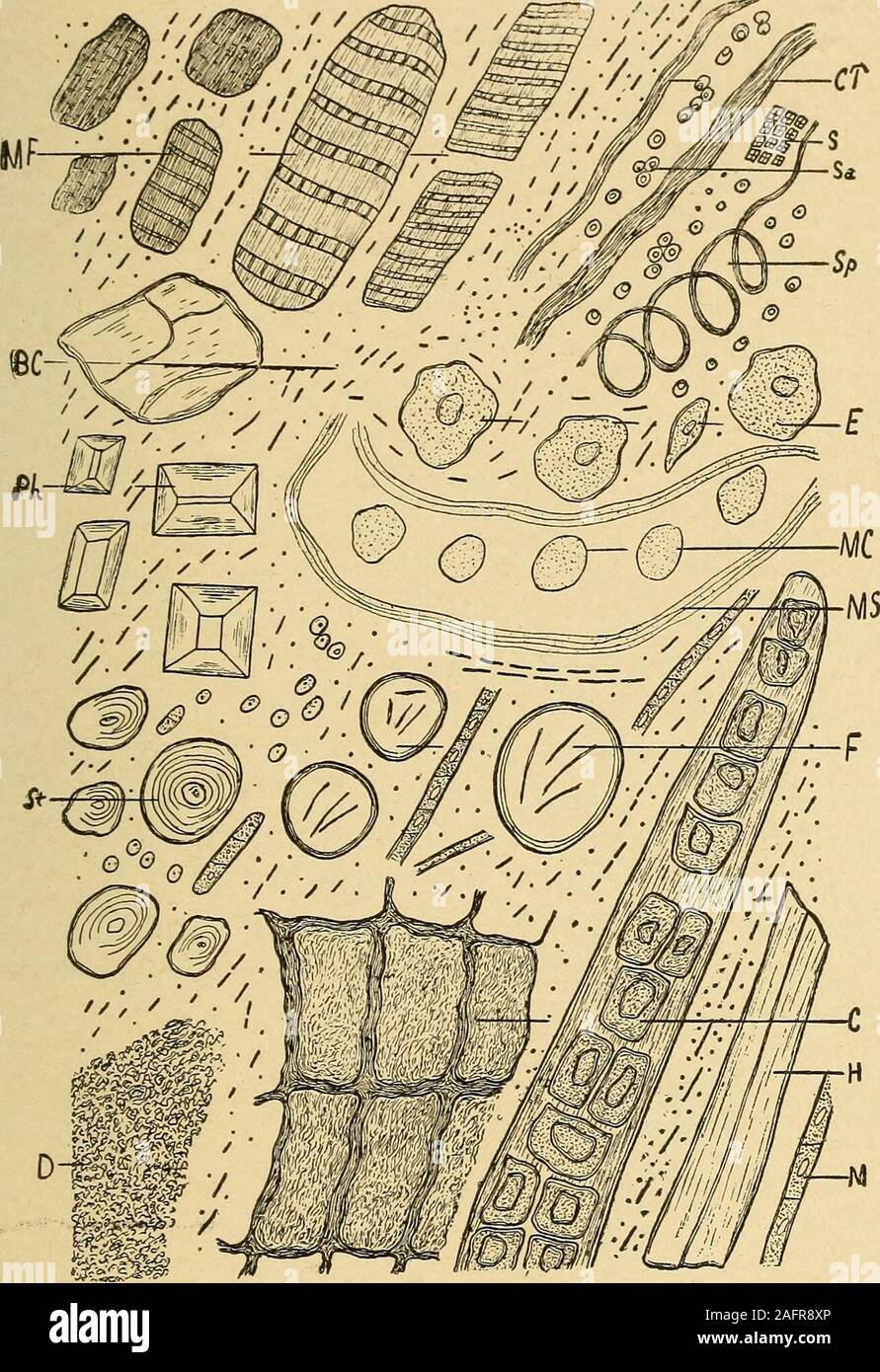 Harnwege Analyse und Diagnose durch mikroskopische und chemische Prüfung.  iriv Abb. 100.- pflanzliches Material (X500). Sp, Spirale Fasern aus Luft -  Schiffe von Pflanzen; V, pflanzliche Fasern; H, Haare von Pflanzen;