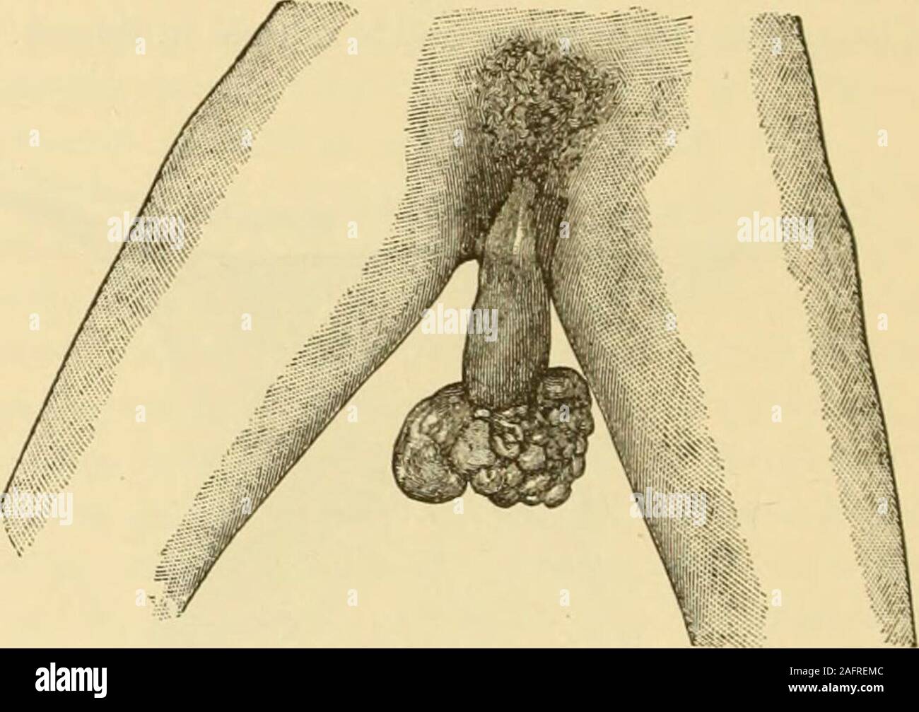 . Klinische gyncology, medizinische und chirurgische. Und gemischte Wucherungen. Diese Tumoren haben ihren Ursprung in der Regel labium majus, obwohl sie nicht auf diesen Teil beschränkt sind, werden manchmal auf thenymphse gelegen. Sie hauptsächlich von faserartigen Bindegewebe bestehen, withsome muskulöse Struktur; Letzteres ist vermutlich abgeleitet von Fasern des ligamentum oder die zahlreichen Muskel - Pakete der Derma. Inappearance sie unterscheiden sich nicht von den lipomata zuvor beschrieben. Myxomata kommen gelegentlich in derselben Ortschaft, und sind so designatedon berücksichtigt das Schwergewicht des myxomatous Gewebe. Stockfoto