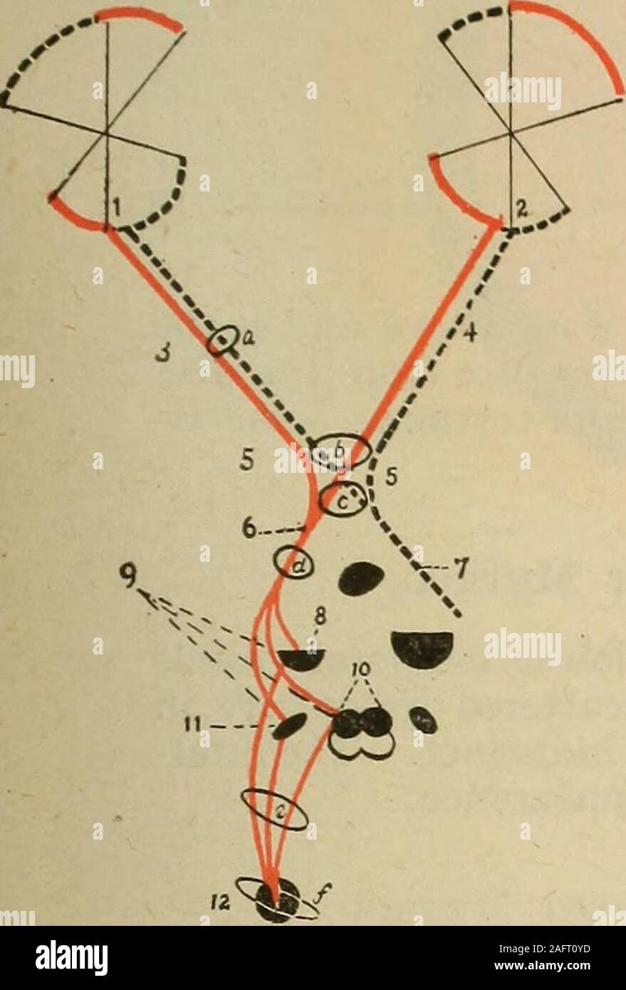 . Medizinische Diagnose für Studenten und Praktiker. Abb. 3. Thrombose der Vene {sogenannten Hämorrhagischen Retinitis) Abb. 4. Albuminuric Retinitis von thorington-s Ophthalmoskop und wie Sie es-0 1 4 TESTS VON VISION 1223. Eindrücke durch ihre Dendriten, die Stäbchen und Zapfen der Netzhaut, die axone an die visuellen Zentren im optischen Thalamus (pulvinar), korpora Quad-core-rigemini und geniculate Gremien, durch die hinteren Teile der inneren Kapsel und schließlich, in der optische Strahlung, der cuneus. Die Axone der nasalen Seiten der Netzhaut, die Stellen die äußeren a Stockfoto