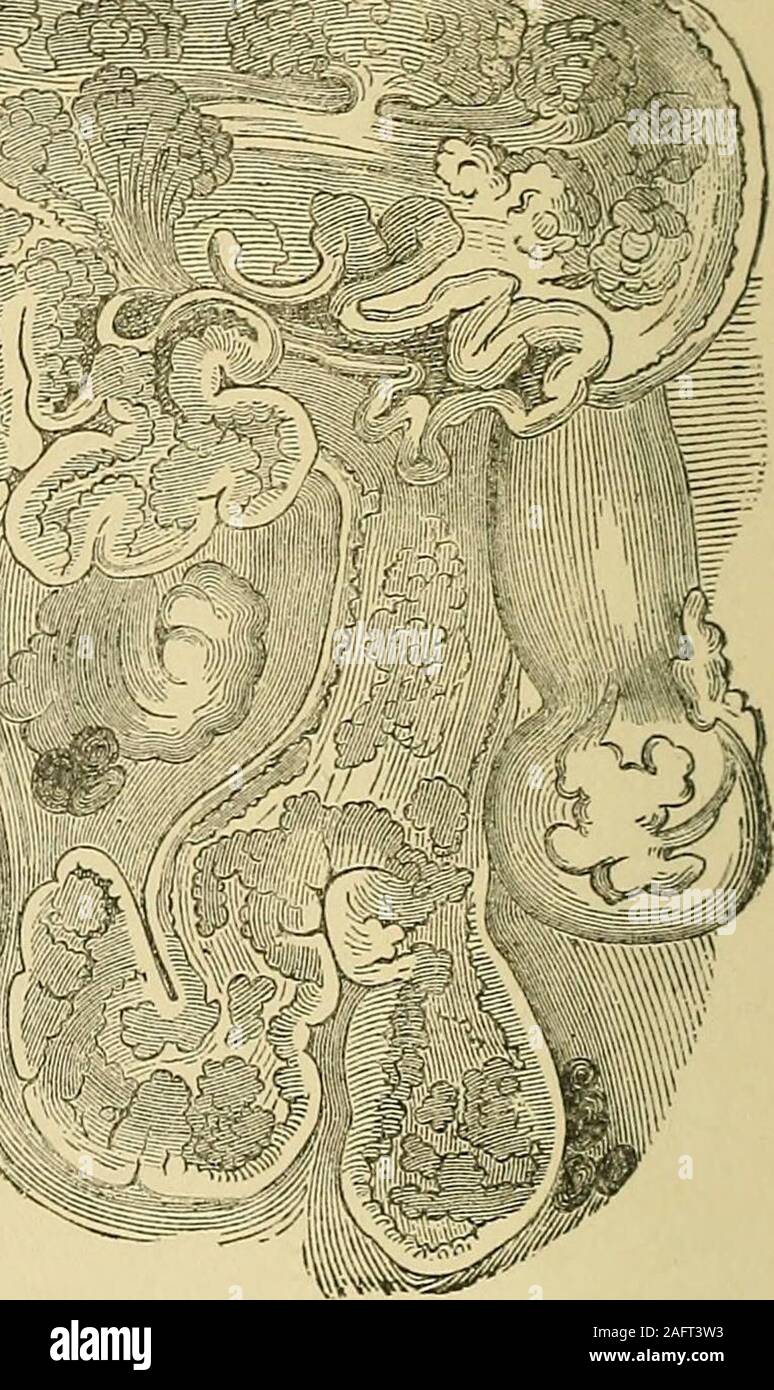 . Cyclopaedia der Geburtshilfe und Gynäkologie. ^m&gt;^^^ Abb. 22.- Teil einer ausgerottet Cysto-Sarcoma des Mamsia. (Nach Meckel-von-Haus-Bach.) etwa die Hälfte der natürlichen Größe. Die begiuning der eigenartige Krankheit ist. gesehen. Dieser balling zusammen der Epithelzellen zu der Bildung von Perlen führen; aber Virchow diese Wucherungen Erwähnungen in cysto-sarcomata der Mamma. Am häufigsten das Epithel ist in homogene Schleim gelöst, whichthen füllt und erweitert die Drüse - Sarkom; einige ausschwitzen kann addedfrom der Schiffe zu dünn sein dieser Schleim. Symptome und. Kurs.-Diese wuchernden cy Stockfoto