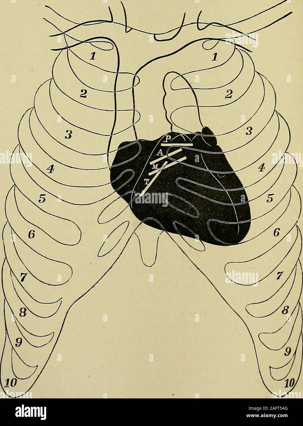 . Erkrankungen des Herzens und der thorakalen Aorta. hird Knorpel in der Nähe des Brustbeins und die unteren und rechten Rand, Krankheiten oft/ie Herzen, vierte Ausgabe, S. 6. 140 Krankheiten des Herzens. Besonders während der systole, hinter der mittleren Zeile des thesternum gelegen, auf einer Ebene mit dem oberen Teil des vierten Knorpel. Mitralklappenstenose. - Die angefügten Kante der Mitralklappe, Entsprechend Walshe, liegt fast horizontal ca. ein Viertel eines Zoll niedriger als der attachedbases der Aortenklappen, sehr leicht weiter nach innen als Diese^ anddeeper innerhalb der Brust als die Trikuspidalklappe. Die beigefügte Stockfoto