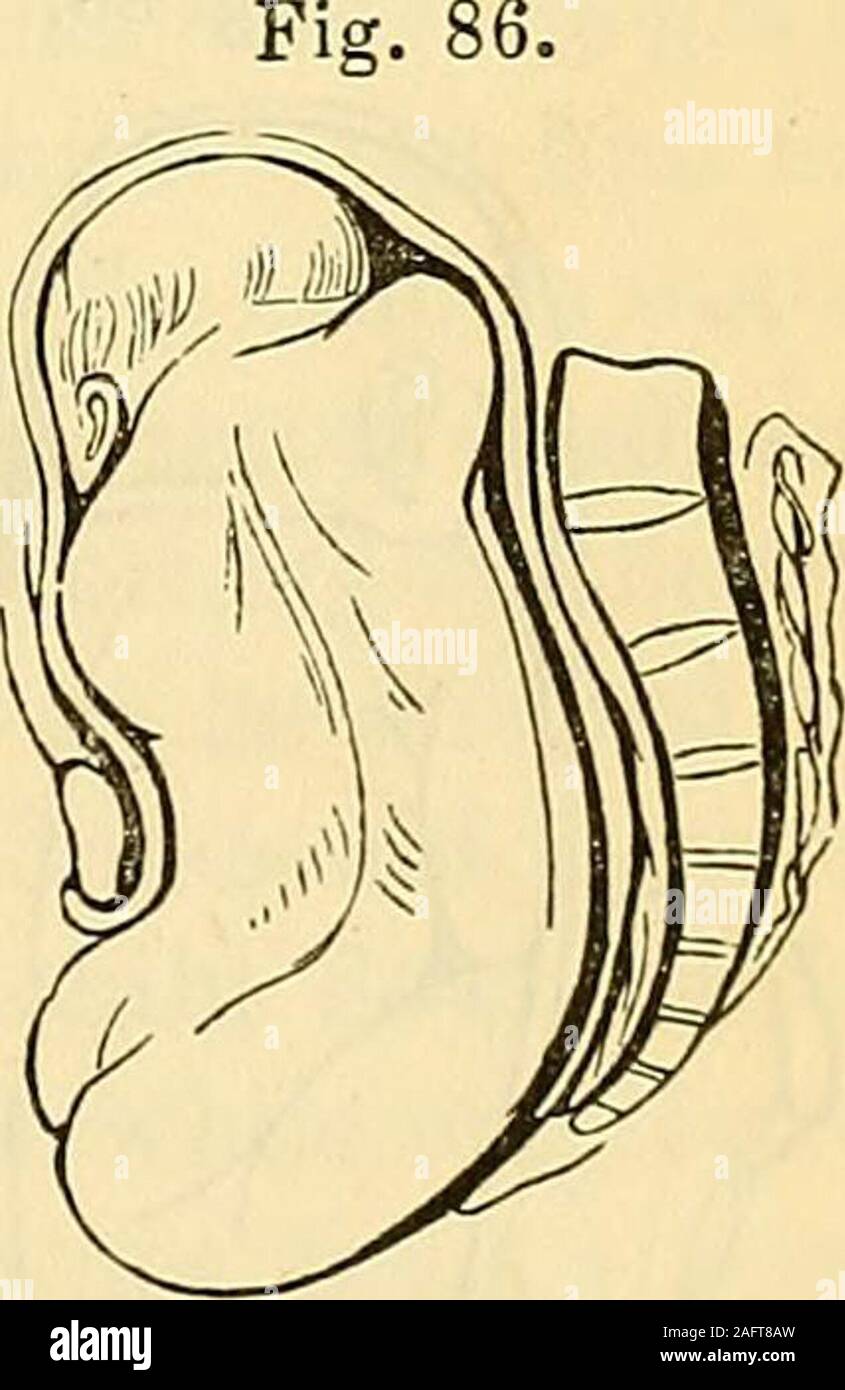 . Geburtshilfe: die Wissenschaft und die Kunst. ck Links acetabulum von themother. 2d, rechts Acetabulum; 3d, auf den schamberg; 4., zu thepromontory. Diese verschiedenen Positionen sind in der Praxis durch die Berührung, whichought nicht in die Irre zu jedem aufmerksamen oder betrachten - easilydiscriminated ate Praktiker, da durch die Touch es leicht ist erfahren Sie, wo sich das Steißbein, der tubera ischii, den Genitalien, den Sulcus zwischen den Schenkeln, thesacrum, &c. &C. Wie die Flucht des breechoccasions Eine große Distension, den Damm wieder eine sorgfältige Unterstützung durch Drücken einer softnapkin gegen es erfordert, mit dem Ziel, erste, Stockfoto