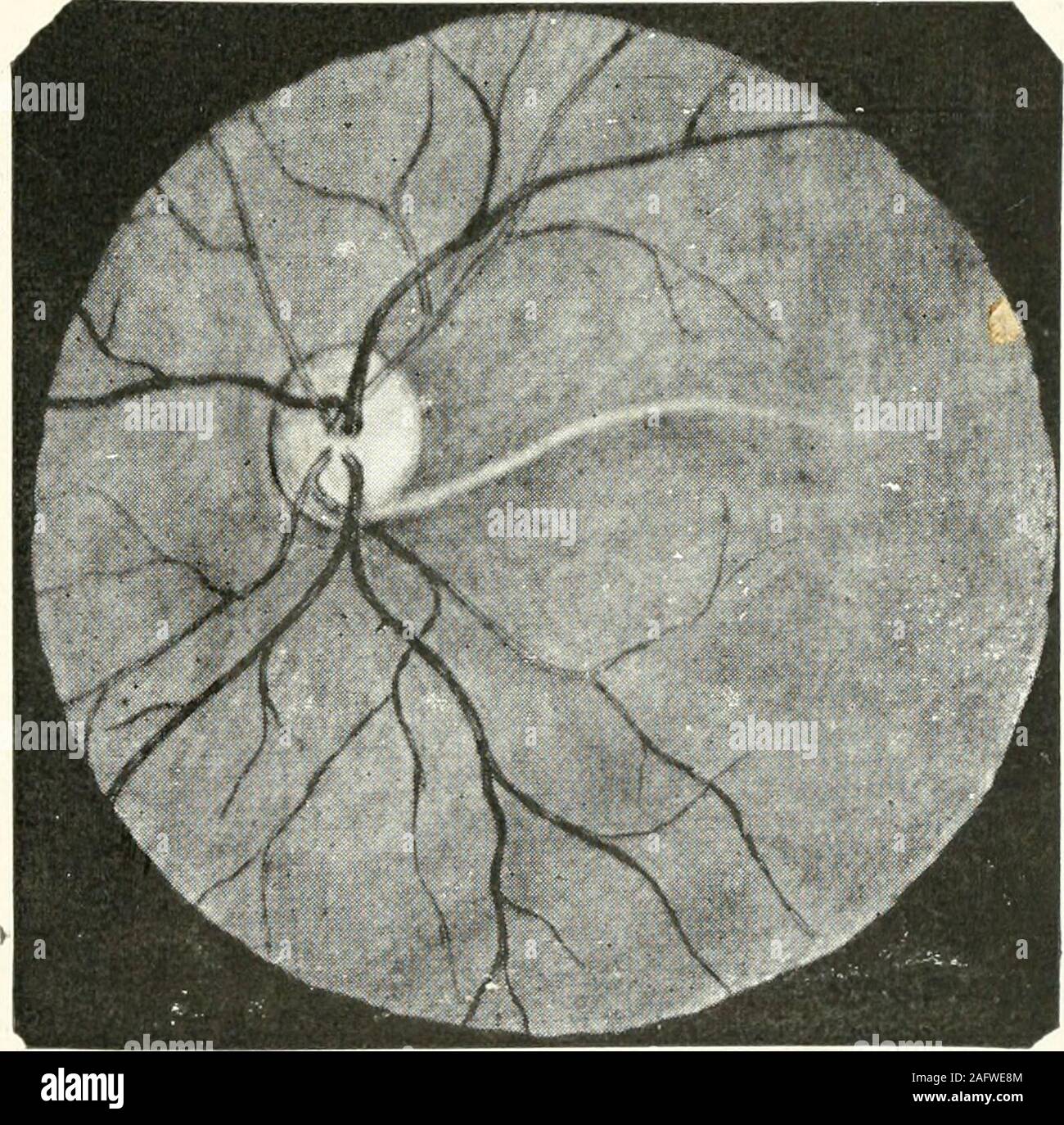 . Oftalmología; estadística [1.]-3. ser. Abb. A.-O. I. Brida anormal de lalámina perforada. Abb. B.-Placas de Fibras de mielina.. Abb. c-Arteria hialoidea persistente. Oftalmología. Plancha,. Stockfoto