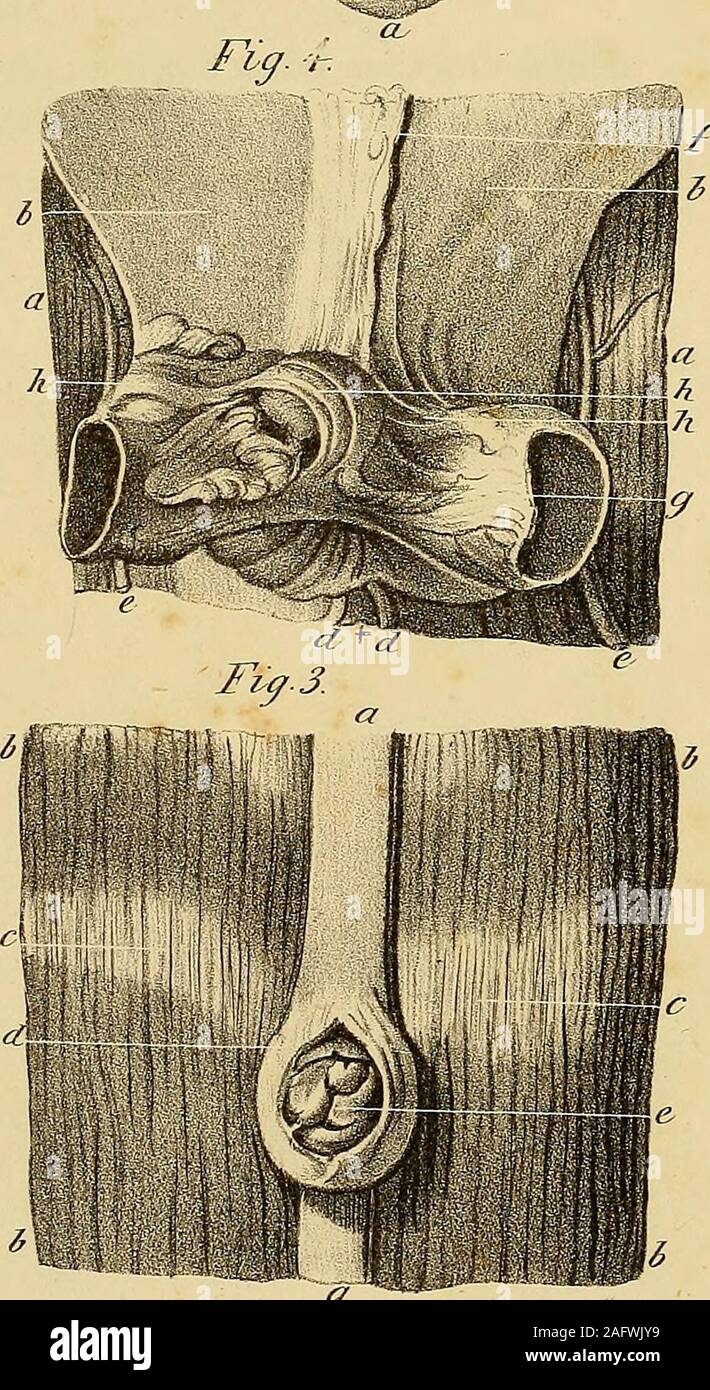 . Die Anatomie und die chirurgische Behandlung der Abdominal- Hernie. GL. J TFrench, Del. Sindazri JLitk. Erläuterung DER PLATTE XXI. 417 g. Darm die Einhaltung der Drossel des hernial Sac. h h. Das Omentum geklebt des Mesenteriums und die hernialsac, bilden eine Tasche auf den Bauch. Abb. 5. Vorderansicht eines ventralen Hernie. a a. Die Abdominal- Muskeln. b b. Linea alba. c. Heterozygotie. * D . Faszie über diese hernie. e. Hernial sac. /. Teile von Fett zwischen dem Stoßfänger und dem Sac. Abb. 6. Hintere Ansicht der FIG. 5. ein. Die Abdominal- Muskeln. b b. Peritoneum. c. Teile der lakritzschnecke am Bauchnabel. d. Nabelschnur Stockfoto