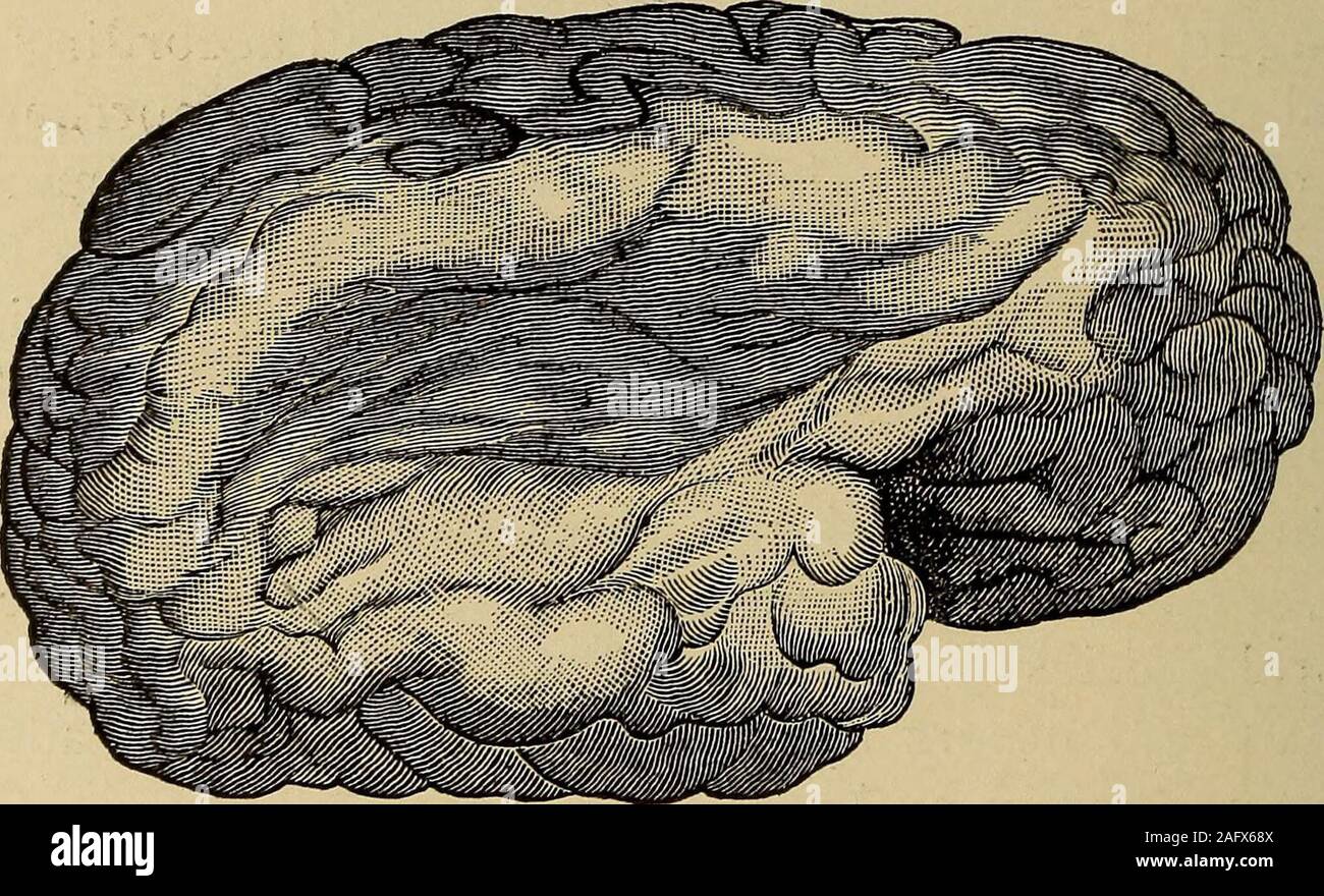 . Eine Abhandlung über das Nervensystem Erkrankungen von Kindern, für Ärzte und Studenten. Alter 23 Lungenembolie 7 Thrombose 5 Tuberkel 1 Insgesamt 78 In 35 Fällen der hemiplegie Blutungen in 23 aufgetreten ist, Lungenembolie und Thrombose in 7, in 5 Fällen. Professor Korbweiden, die 90 Gehirne untersuchte, fand eine vaskuläre Läsionen in 16 Nur, und unter diesen 16, 7 wegen Blutungen waren, und 9 zu Lungenembolie; aber wir dürfen nicht vergessen, dass eine große Anzahl der zystischen Bedingungen infolge Blutung oder em - 450 das nervöse KRANKHEITEN DER KINDER sein kann. bolism, und dass viele ein Fall zitiert wird als typicalatrophy oder porencephalus kann auch gehören zu Stockfoto