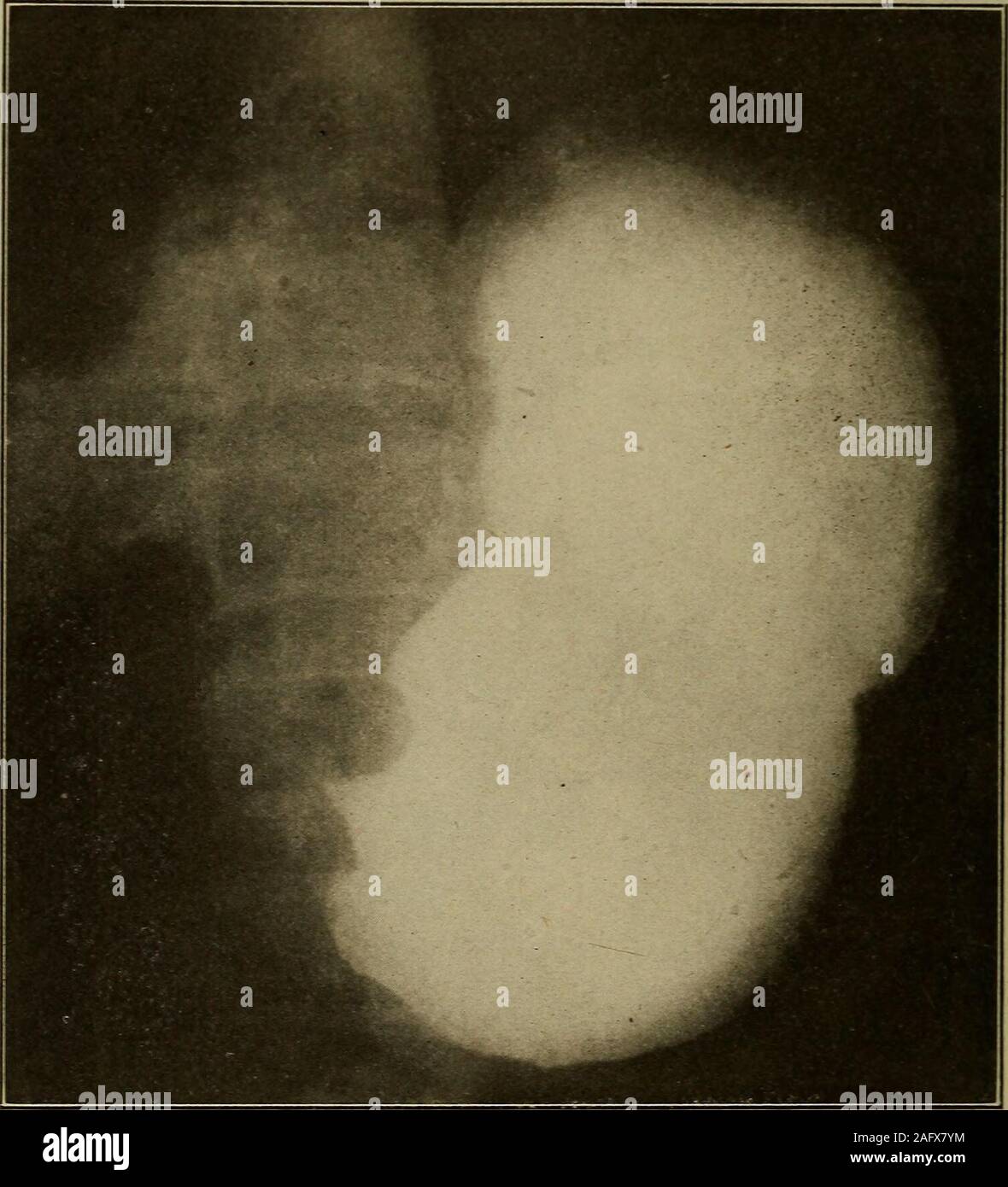 . Medizinische Diagnose für Studenten und Praktiker. Abb. 434.- angeborene Atresie der Speiseröhre. Hinweis distention des Magens andintestine mit Luft. Dies war bei der Autopsie durch eine Union der distalen Ende des theesophagus und die wichtigsten Bronchus erläutert. (Dr. Frank S. Bissell.) Dies ist die Art in der Regel in der männlichen stout Habitus beobachtet. Es israrely in der weiblichen gesehen. Verschiedene Arten, je nach Muscu - 836 medizinische Diagnose normal Reten- perioden. Significanceof verzögern. lar Ton der Magen, als auch die Länge der Mesenterium describedas sind: (i) Hypertone. (2) Orthotonic. (3) Hy Stockfoto