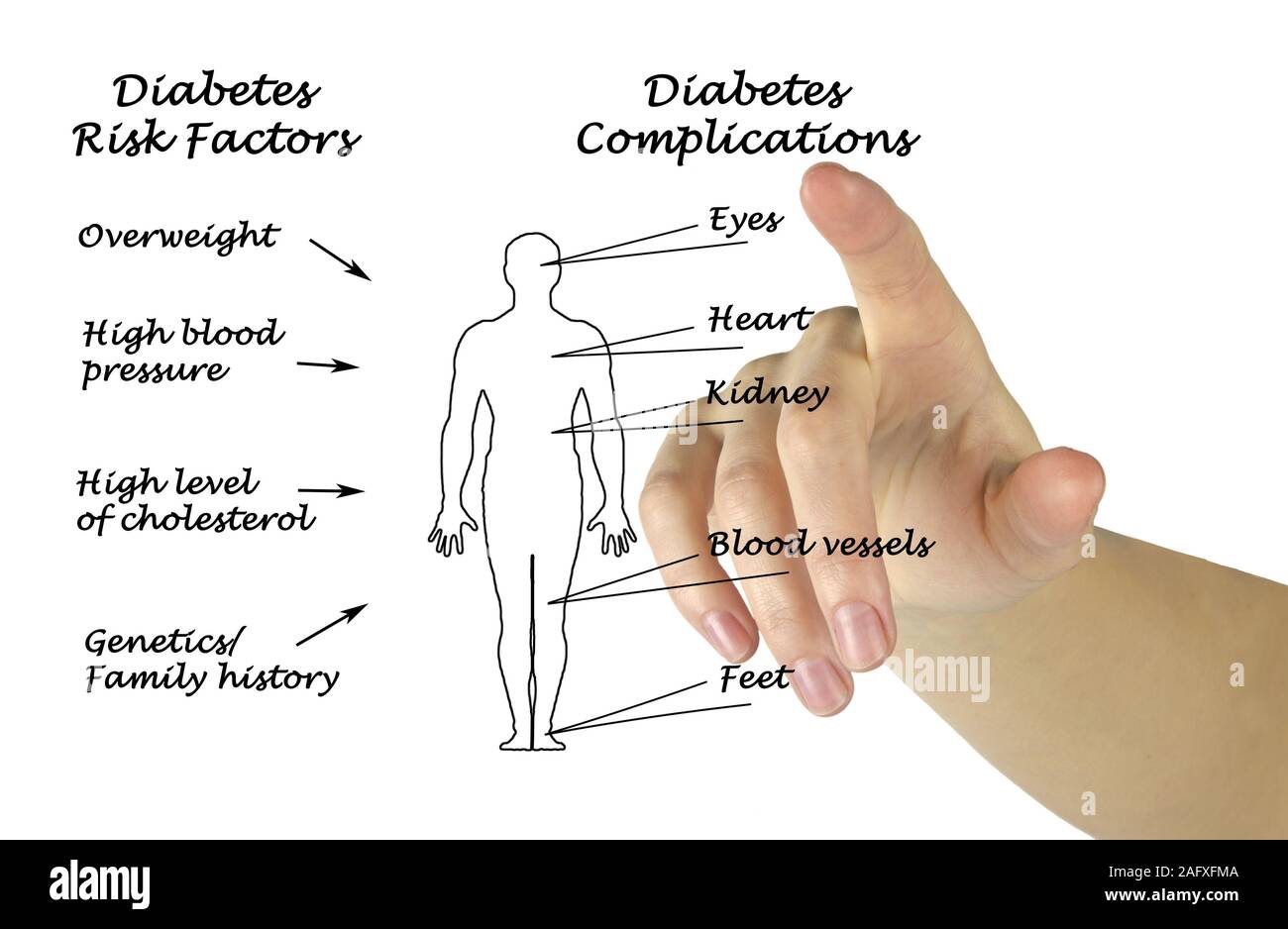 Diabetes Risikofaktoren und Komplikationen Stockfoto