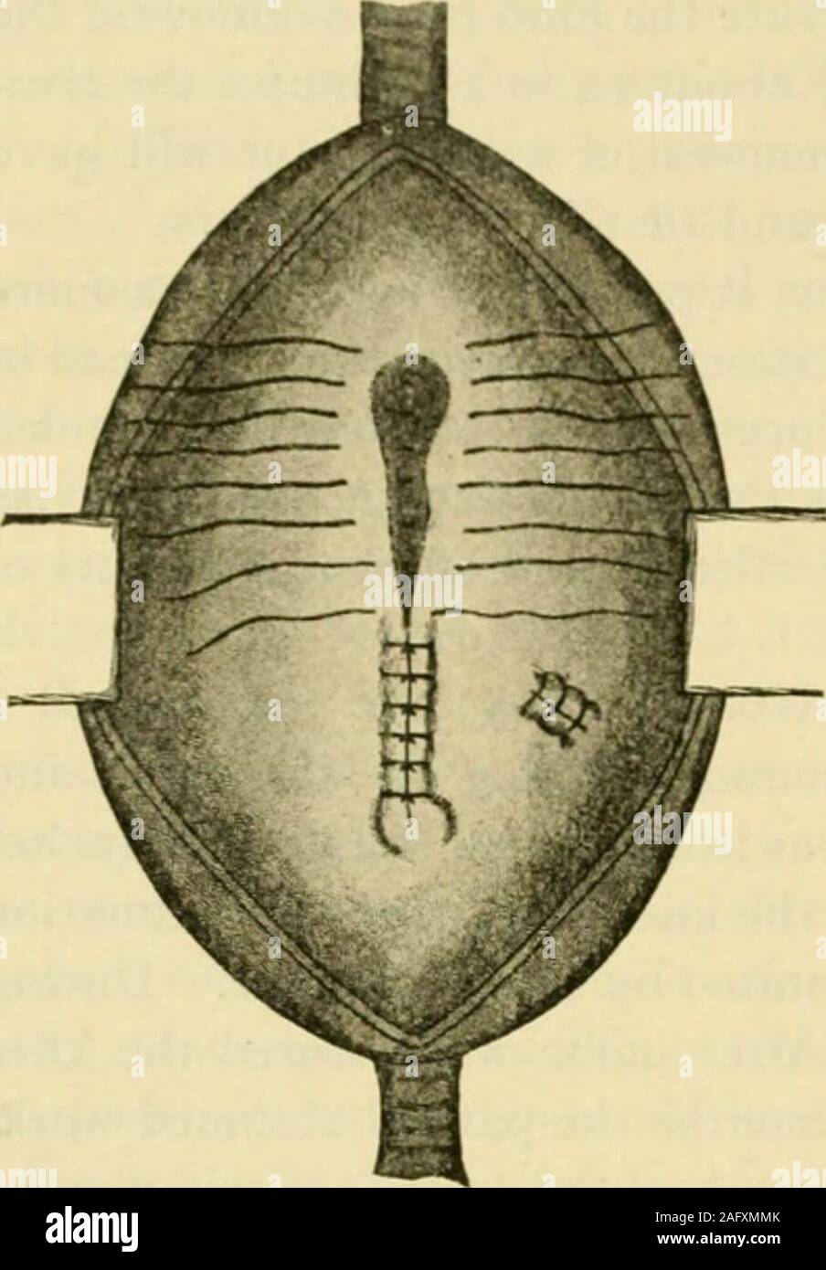. Handbuch der operativen Chirurgie. Des sac und seine Wände eingezogen, so dass alle theorifices, die in es offen sichtbar sind. Hinweis Wenn es gibt zwei Öffnungen un - durch eine Nut von mehr oder weniger normalen Arterienwand verbunden. Wenn dies der casethe aneurysm ist Fusiform und geeignet für die bronchiolitis. Wenn diebeiden Öffnungen sind durch eine Nut von mehr oder weniger gesunden arteriellen Wand verbunden, Hinweis Wenn diese Nut ist breit und enthält genug und ausreichend gutes Gewebe topermit Rekonstruktion der Arterie. Wenn die Nut ist schmal und aus ofsuspicious Gewebe, das Aneurysma ist entweder fusiform oder Stockfoto