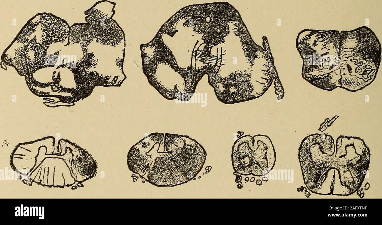 . Eine Abhandlung über das Nervensystem Erkrankungen von Kindern, für Ärzte und Studenten. Abb. 72.- Degeneration des theCauda Equina in MultipleSclerosis. (Nach Taylor. ) 3 o8 das nervöse KRANKHEITEN DER KINDER. Die Erkrankung bei Eltern und Kind zu finden. Die Fälle ofPelizaeus, zustimmend, die von einigen Autoren zitiert, sind nicht tomy Verstand typische Fälle von Multipler Sklerose; Sie belongrather in den erblichen Form der spastische Lähmung. KrafftEbing, andere erwähnen Kältetechnik als häufiger etio - logische Faktor. Pathologische Anatomie. - können wir folgern aus der namethat der Chief Läsionen in dieser Krankheit Irregul sind Stockfoto
