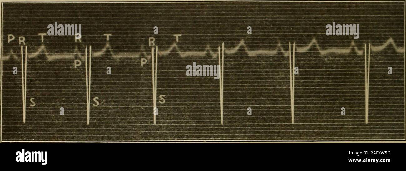 . Medizinische Diagnose für Studenten und Praktiker. Abb. 404.- Leitung iii Feigen. 402, 403, 404.- Angeborene Herzfehler; mitral Ps; verzögerte Überleitung von auricleto Ventrikel (teilweise Herz Block). Ableitung i zeigt die typische Split (Zahnriemen) P von mitralstenosis; die weniger klar angegeben Mitralklappe P in Form eines quadratischen Gipfel; die (relativ) kleinen R in Ableitung i und tiefen S in Ableitung II, der auf eine angeborene Element; aP-R-Intervall von 0,3 Sek. als mit dem normalen P kontrastiert-R von 0,12-0.18 Sec. (R. Edwin Morris.) Dekade des Lebens. Mit defekten ventrikulären Septum nur wenige überleben die firstseven Jahre und Fe Stockfoto