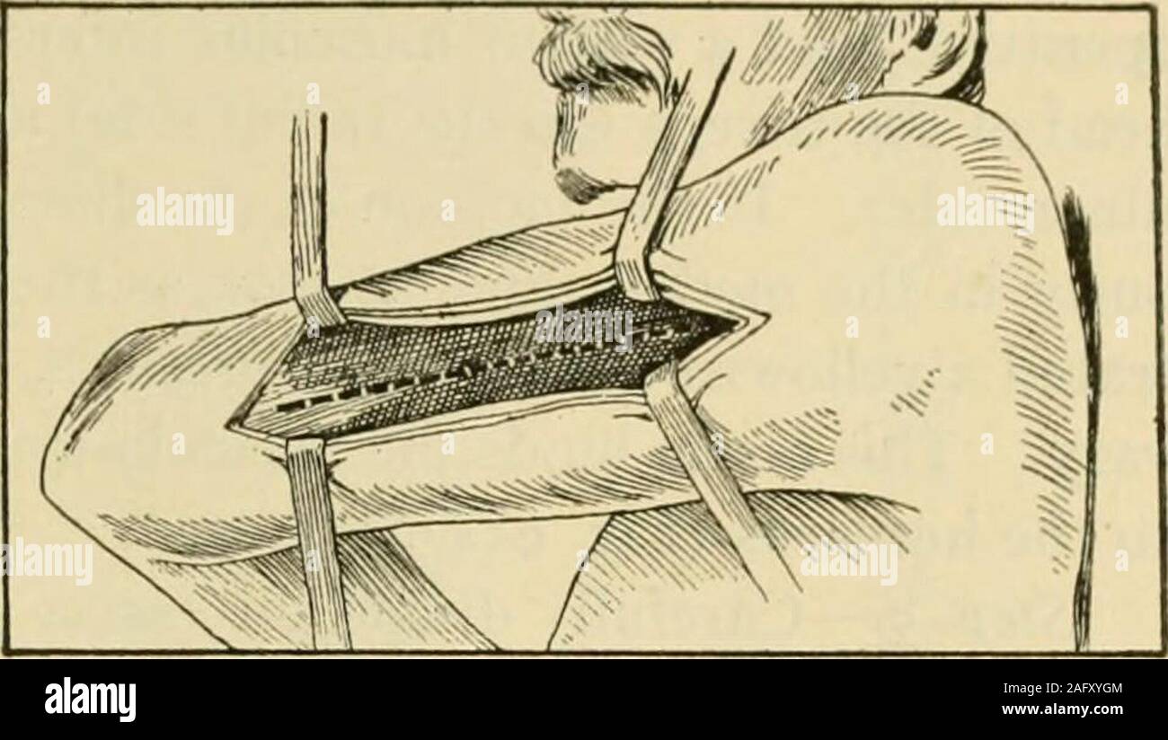 . Handbuch der operativen Chirurgie. nee. Das kniegelenk wird erweitert. Ein Schnitt, ein Zoll und eine Hälfte in der Länge, ist parallelwith und sofort posterior auf die Sehne des Bizeps. Der Schnitt shouldbe so platziert, dass die obere Hälfte ist in Bezug auf die Sehne, während seine lowerhalf über die Fibel ist. Die Haut und tiefen Faszie in unterteilt, die bicepstendon ausgesetzt ist. Das Knie sollte jetzt ein wenig gebeugt werden und der nervesought, in der Nähe der Stelle, an der die Sehne erreicht die Leiter der Fibel. Eine schmale und Unrecht prominente ilio-tibial Band für thebiceps Sehne geirrt hat. Gesichtsbehandlung Stockfoto