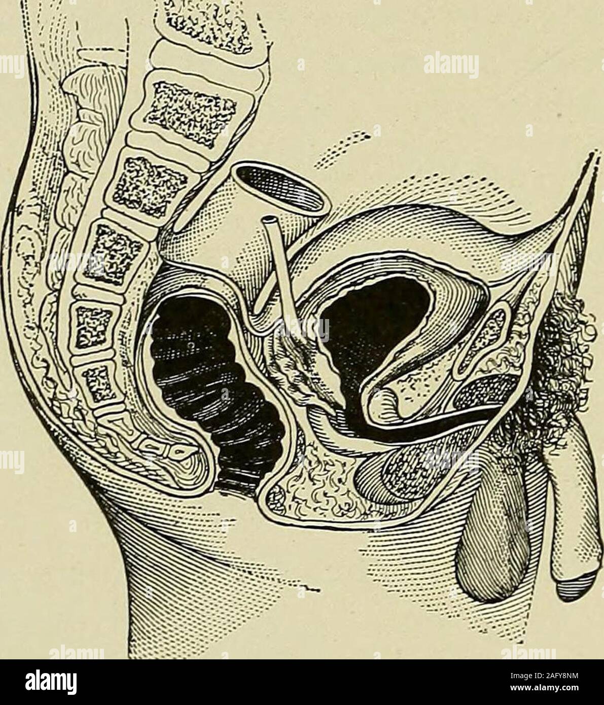 . Erkrankungen des Rektum und Anus: für Studenten und Praktiker der Medizin konzipiert. nt. Das OS Steißbein zu beiden Seiten abweichen können: seitliche Krümmung; vorwärts gegen das Rektum: anterior Krümmung (Abb. 46); orbackward, prominent angezeigt unter der Haut: posteriorcurvature (Abb. 47). In forzvard Mißbildung das Rektum ist caughtbetween fäkale Ansammlungen und dem Ende der Knochen, wodurch (149) 150 KRANKHEITEN DES Rektum und Anus Geschwürbildung, und manchmal Perforation und Projektion von thetip des Knochens in den Darm. Im hinteren Krümmung der skinover der Knochen normal sein kann, bläuliche Farbe Stockfoto