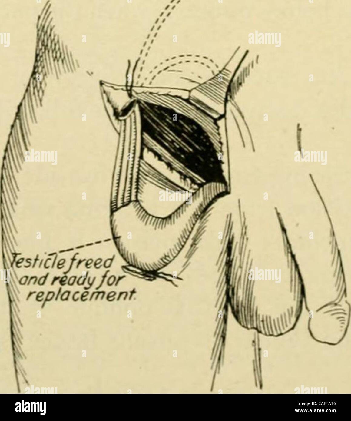 . Handbuch der operativen Chirurgie. 3 p* rma/ic rtiU/i Ifui es nJ^om ntcmtry - bevans Betrieb. Abb. 913. (Bevan.) vas nach unten und nach innen aus den inneren Ring. Die oben genannten maneuversshould so das Kabel, das die Hoden auf dem Oberschenkel drei orfour Zoll unter Pouparts Ligament (Abb. erlassen werden verlängern. 914). Es sei denn, die Verlängerung der Thecord in dem Maße erwähnt wird, andere Maßnahmen erlassen werden tosecure die erforderliche Entlastung der Spannung.. Abb. 914.- bevans Betrieb. (Bevan.) Schritt 4 - die Finger von der Wunde Pass in den Hodensack und bilden eine pocketthere. In diese Tasche die Hoden verstauen. Stockfoto