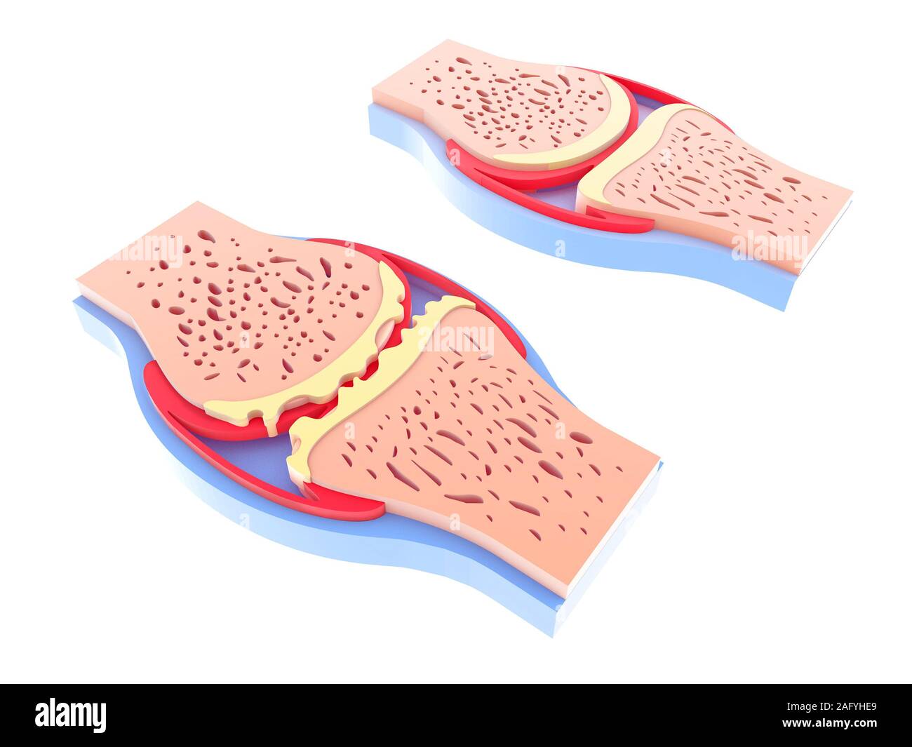 3d-Abbildung der gesunden synovial Joint und mit Arthrose. Bilder auf weißem Hintergrund gelehnt auf dem Boden isoliert. Lebendige Farben. Stockfoto