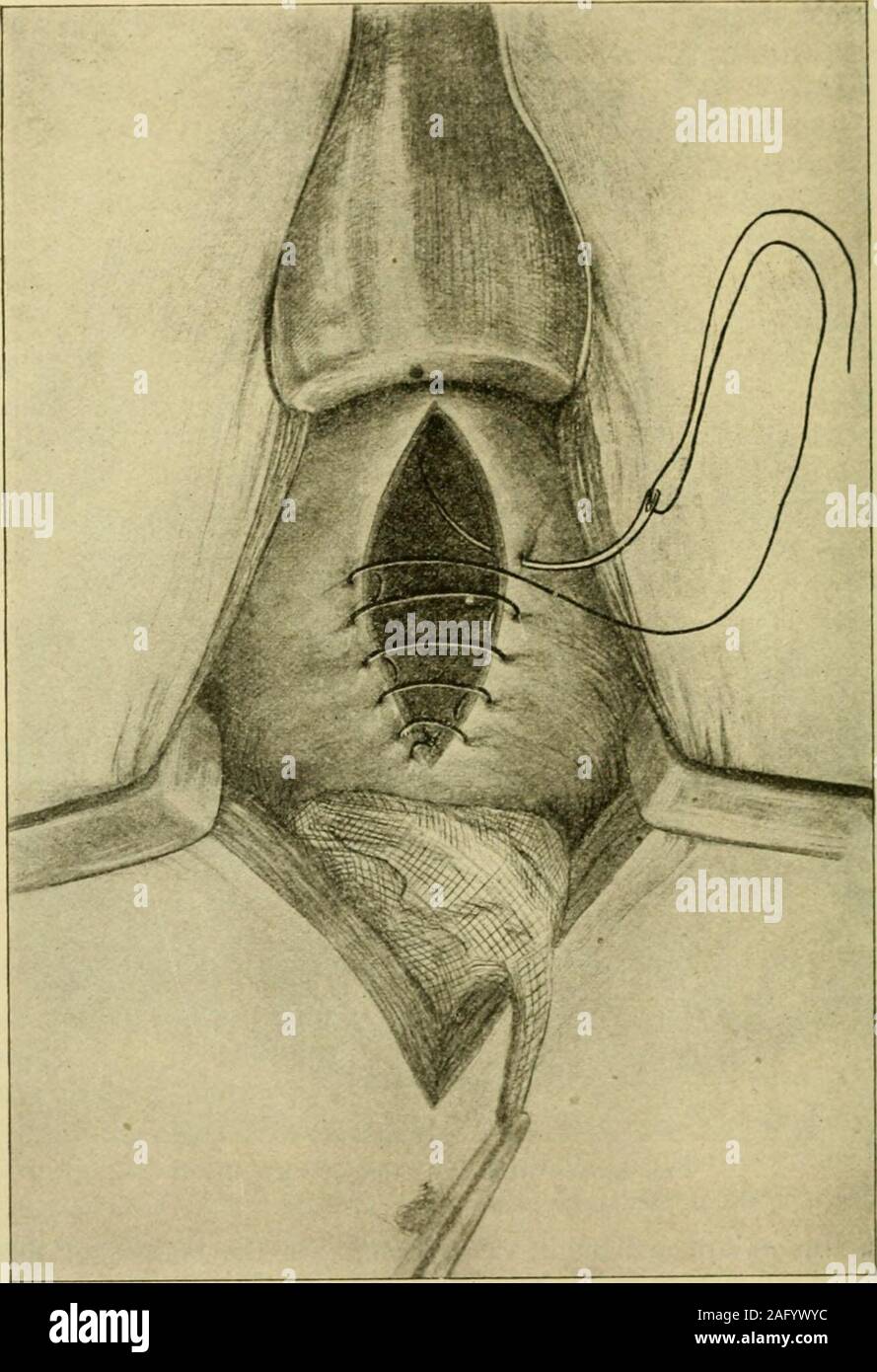 . Handbuch der operativen Chirurgie. eans ofthe Elektrokauterisation Messer. Versuchen Sie nicht, das Wachstum mit der elektrokauterisation zu zerstören, butlift es mit Pinzette und Sezieren entfernt, können Sie über die elektrokauterisation wie ein Messer. 4. In der Nähe der Wunde in der Blase durch die durch und durch Catgut stitchesintroduced im Connel Mode (Abb. 847). In einer zweiten Schicht von Stichen (Hanf) in der fortlaufenden Lembert oder schwärmerisches Mode. Am unteren Ende der Cut, wo die Blase nicht mit Peritoneum bedeckt, ist es einfach, so loosenthe parietalen Bauchfells kontinuierlich mit der vesical Peritoneum, dass Es Bemade kann auf die Blase und pe zu liegen Stockfoto