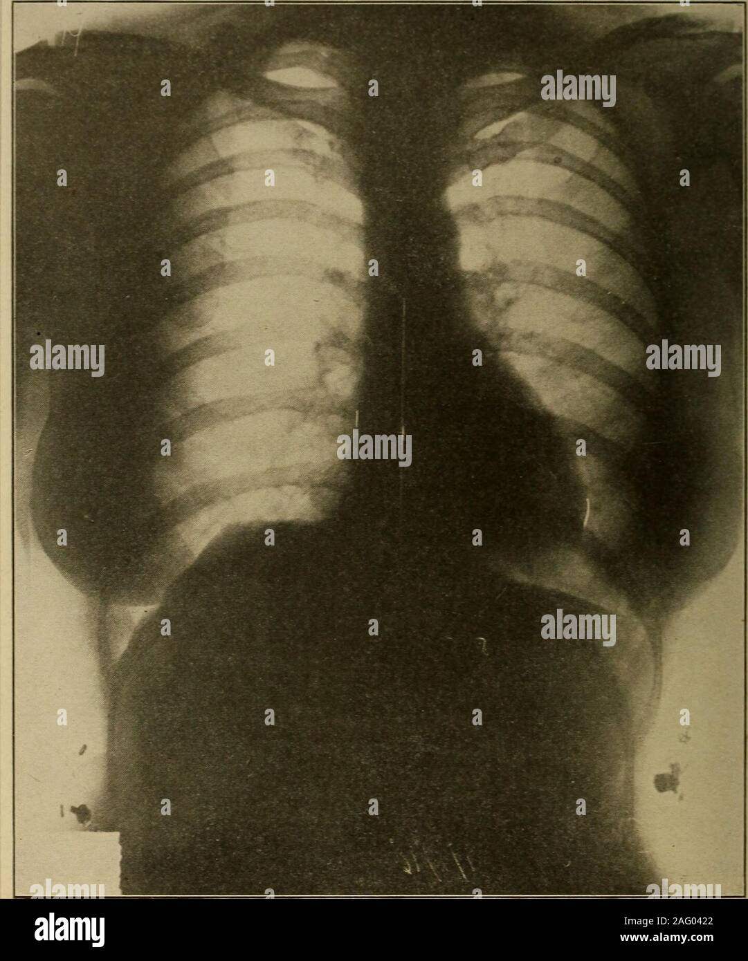 . Medizinische Diagnose für Studenten und Praktiker. Abb. 336.- Aortenklappeninsuffizienz und Mitralklappeninsuffizienz auf einem dropheart überlagert. Nach mehreren Jahren im Herzen eine transversale Durchmesser von 11,5 cm erreicht hat. Ml. 8.5; Herr, 3 cm; insgesamt. 11,5 cm. Die Qualität ist auch besser im Original Negativ. Die Patienten finden war deutlich beeinträchtigt. Erhöhung der Langlebigkeit, mit denen, die jetzt in der Tuberkulose gewonnen. Man kann nicht, wenn die butsurmise cardiopath im Verhältnis zu der Präsenz von orincrease decompensatory Anzeichen infektiöser waren, würde er besser. 634 medizinische Diagnose Stockfoto