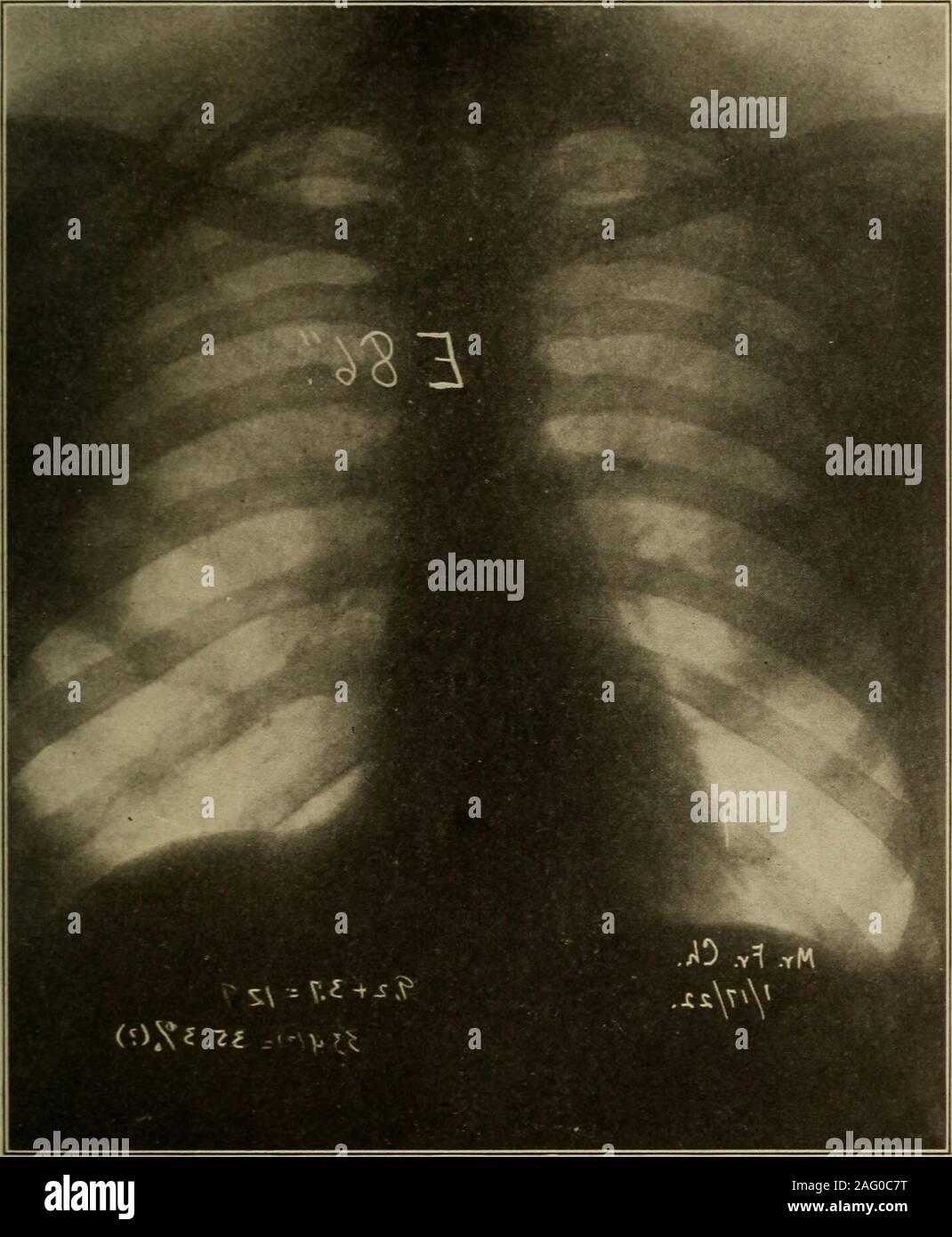 . Medizinische Diagnose für Studenten und Praktiker. Abb. 320.- Gastroptosis mit unzureichender Tropfen Herz in Abb. 1 gezeigt. 319. Obligatorische Einwirkung widriger Einflüsse. - Die negativen influencesoperating auf die Opfer der universelle angeborene Asthenie, die in den Militärdienst beeninducted hatte sehr variiert mit der Art des Service demandedof ihn aber auf dem ganzen everv Faktor berechnet den TROPFEN HERZ 617 die Reserve von einem beträchtlichen Teil der jungen Erwachsenen die thisconstitutional Mangel zu durchbrechen. Wie festgestellt wurde, das Element der Selbstschutz oft unconscio Stockfoto