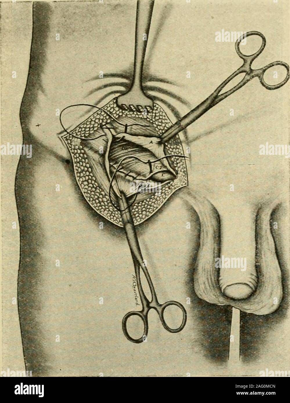 . Handbuch der operativen Chirurgie. In der Johns HopkinsHospital. Es ist in der ursprünglichen Funktion der Halsted, von Ihm verändert - selbst und Bloodgood. (Johns Hopkins Bulletin, August, 1903.; Schritt I - die Haut und der aponeurosis der externen obhque asin Die Bassini nicht teilen. Spiegeln die aponeurotic klappen. Schritt 2 - Die cremaster Muskeln und Faszien Split entlang einer Linie ein wenig abovethe Mitte der Schnur. Leistenbruch 6 ii Schritt 3. klar machen die interne oblique Muskel neben dem Kanal. Schritt 4 - Die hernie und die Kabel prüfen. Wenn die Venen sind groß, andthis ist in der Regel der Fall ist, Verbrauchsteuern Stockfoto